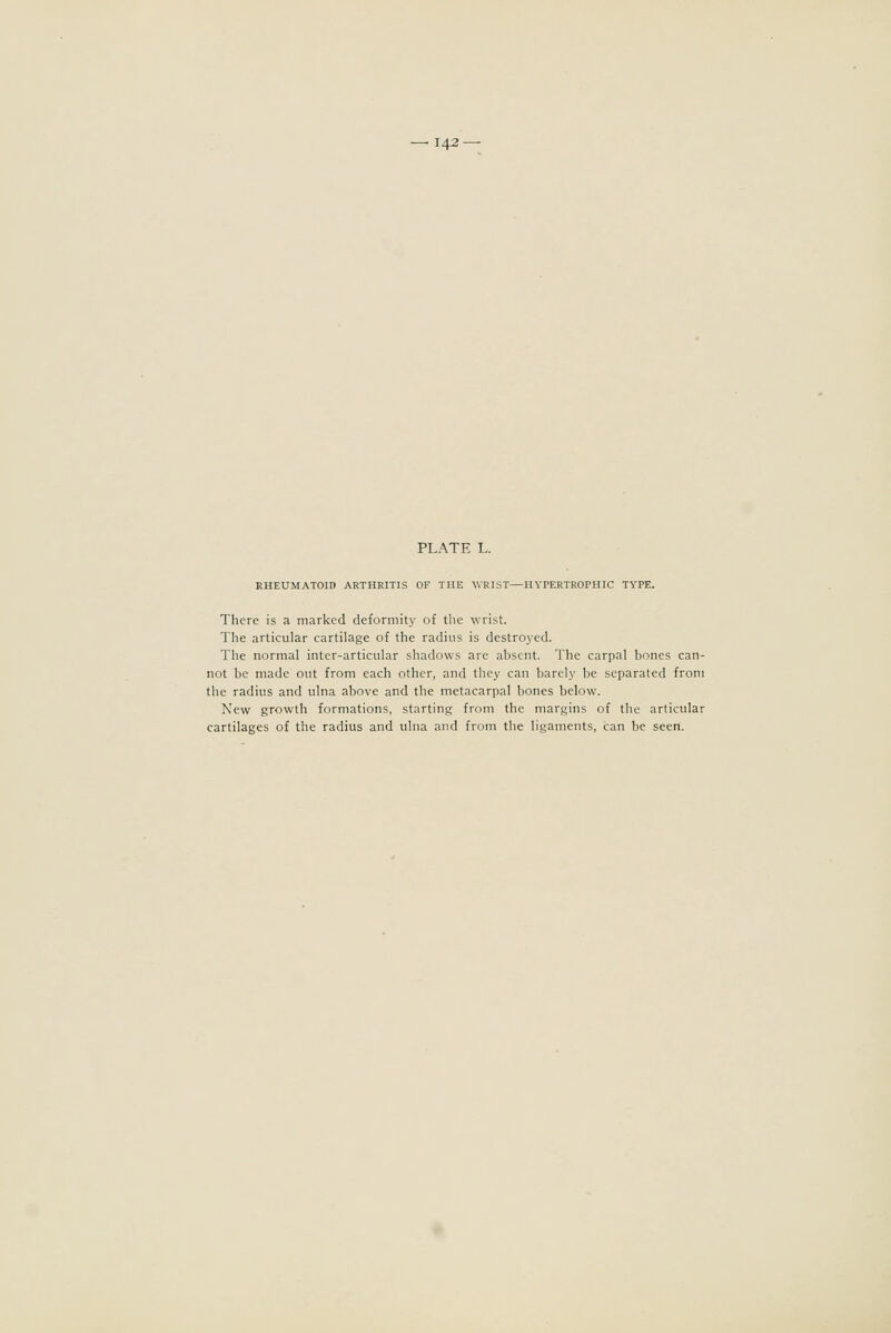 PLATE L. RHEUMATOID ARTHRITIS OP THE WRIST—IIYPERTROrHIC TYPE. There is a marked deformity of the wrist. The articular cartilage of the radius is destrojed. The normal inter-articular shadows are absent. The carpal bones can- not be made out from each other, and they can barely be separated from the radius and ulna above and the metacarpal bones below. New growth formations, starting from the margins of the articular cartilages of the radius and ulna and from the ligaments, can be seen.