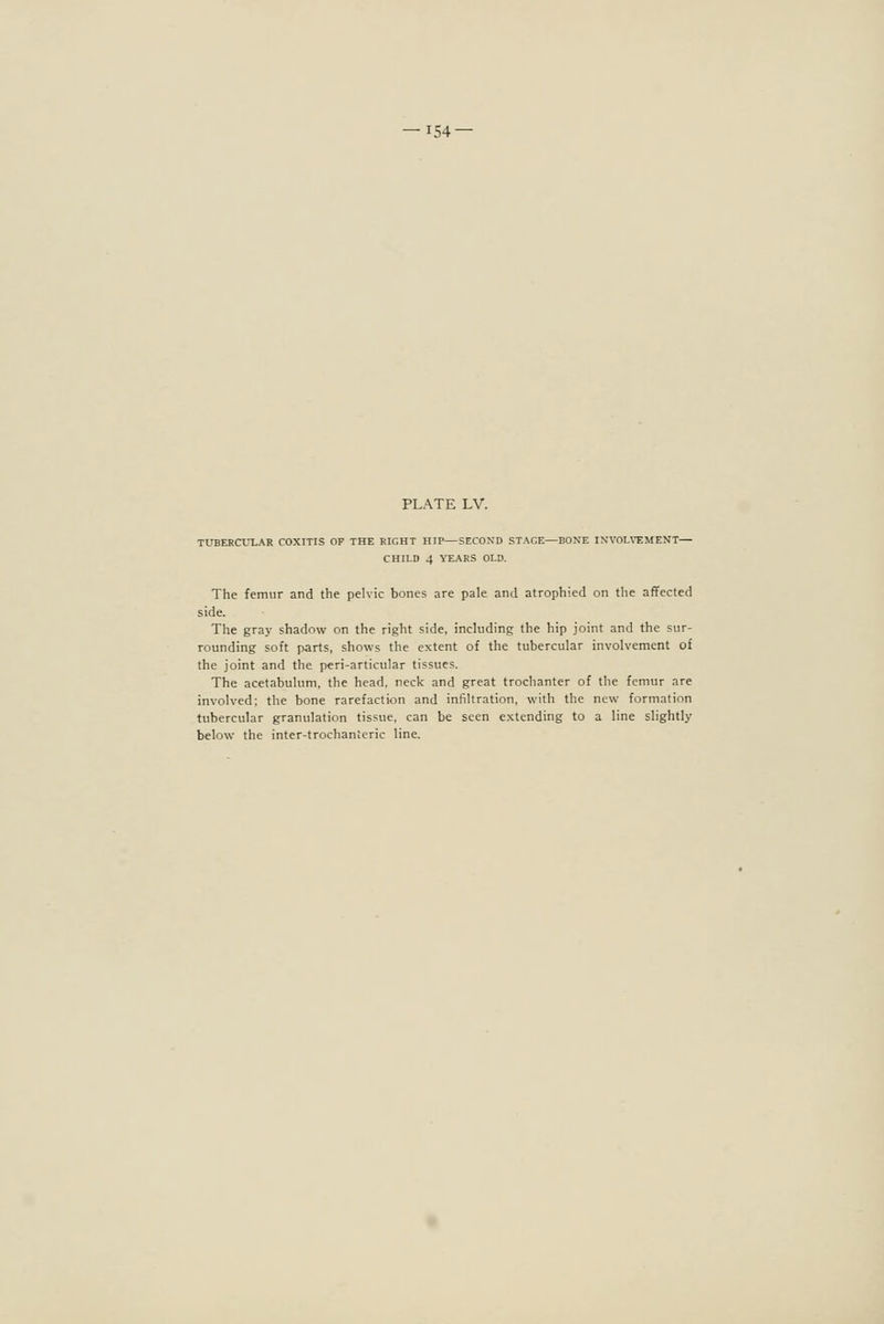 PLATE LV. TUBERCLXAR COXITIS OF THE RIGHT HIP—SECOND STAGE—BONE INVOLVEMENT— CHILD 4 YEARS OLD. The femur and the pelvic bones are pale and atrophied on the affected side. The gray shadow on the right side, including the hip joint and the sur- rounding soft parts, shows the extent of the tubercular involvement of the joint and the peri-articular tissues. The acetabulum, the head, neck and great trochanter of the femur are involved: the bone rarefaction and infiltration, with the new formation tubercular granulation tissue, can be seen extending to a line slightly below the inter-trochanteric line.