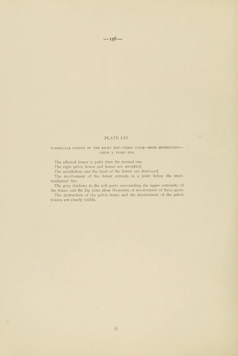 -156- PLATE LVI. TfRERCrLAR COXITIS OF THE RIGHT HIP—THIRD STAGE—BOXE DESTRUCTION— CHILD 4 YEARS OLD. The affected femur is paler than the normal one. The right pelvic bones and femur are atrophied. The acetabulum and the head of the femur are destroyed. The involvement of the femur extends to a point below the inter- trochanter line. The gray shadows in the soft parts surrounding the upper extremity of the femur and the hip joint show theextent of involvement of these parts. The destruction of the pelvic bones and the involvement of the pelvic tissues are clearly visible.