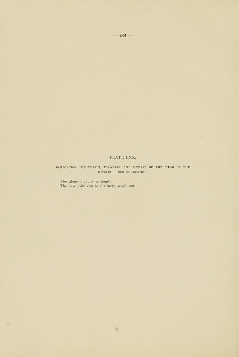 —188 — PLATE LXX. DISLOCATION DOWNWARDS, FORWARDS AND INWARD OF THE HEAD OF THE HUMERUS—OLD DISLOCATION. The glenoid cavity is empty. The. new joint can be distinctly made out.