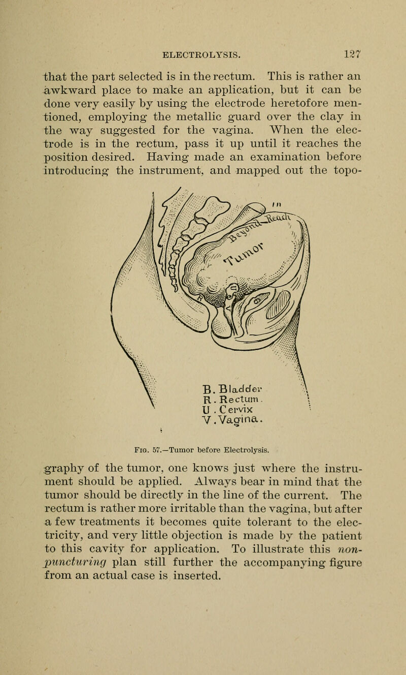 that the part selected is in the rectum. This is rather an awkward place to make an application, but it can be done very easily by using the electrode heretofore men- tioned, employing the metallic guard over the clay in the way suggested for the vagina. When the elec- trode is in the rectum, pass it up until it reaches the position desired. Having made an examination before introducing the instrument, and mapped out the topo- B.BlaLclcfev R. Rectum. U . C ervix Y, Vagina. Fig. 57.—Tumor before Electrolysis. graphy of the tumor, one knows just where the instru- ment should be applied. Always bear in mind that the tumor should be directly in the line of the current. The rectum is rather more irritable than the vagina, but after a few treatments it becomes quite tolerant to the elec- tricity, and very little objection is made by the patient to this cavity for application. To illustrate this non- puncturing plan still further the accompanying figure from an actual case is inserted.