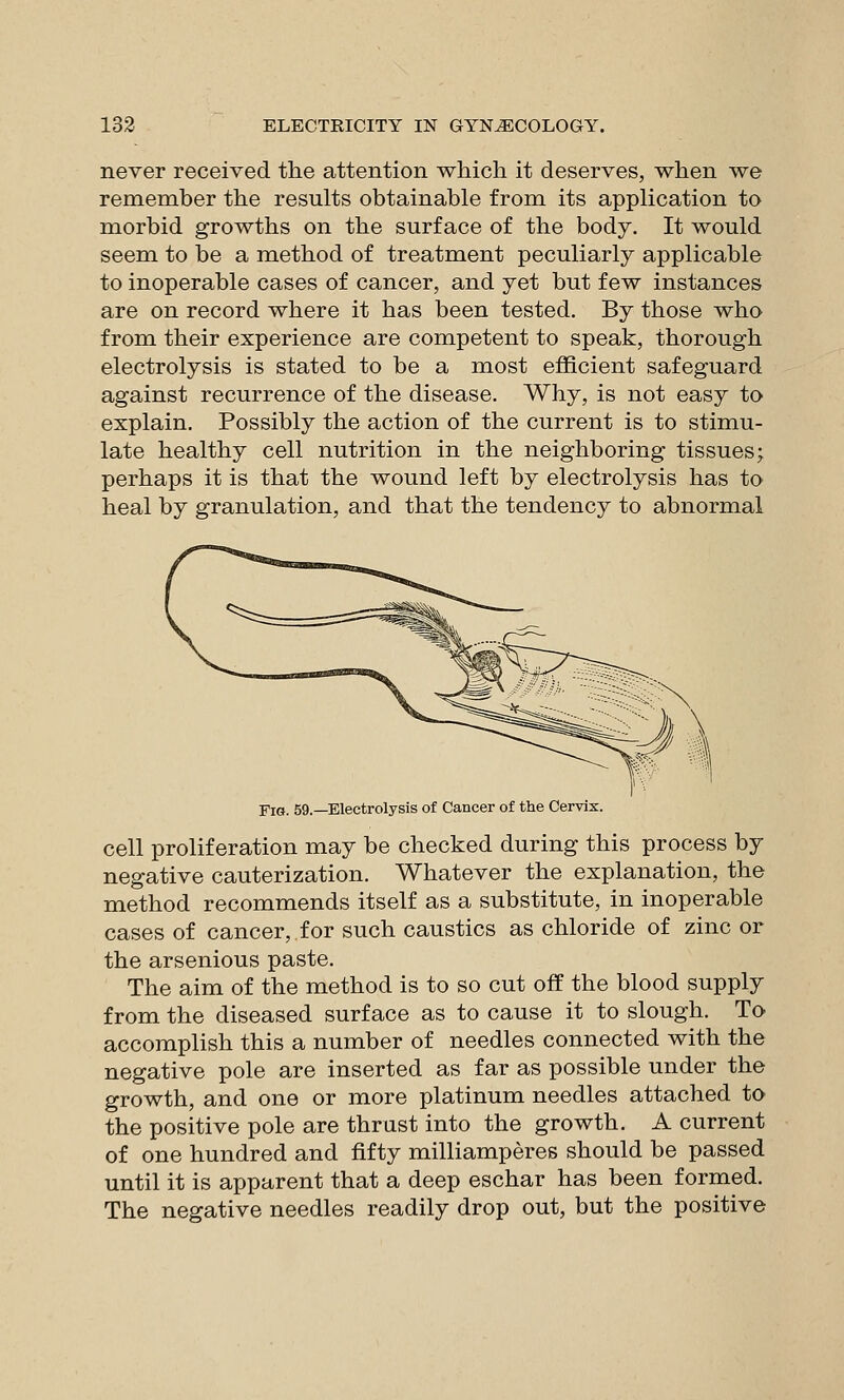 never received the attention which it deserves, when we remember the results obtainable from its application to morbid growths on the surface of the body. It would seem to be a method of treatment peculiarly applicable to inoperable cases of cancer, and yet but few instances are on record where it has been tested. By those who from their experience are competent to speak, thorough electrolysis is stated to be a most efficient safeguard against recurrence of the disease. Why, is not easy to explain. Possibly the action of the current is to stimu- late healthy cell nutrition in the neighboring tissues; perhaps it is that the wound left by electrolysis has to heal by granulation, and that the tendency to abnormal Fig. 59.—Electrolysis of Cancer of the Cervix. cell proliferation may be checked during this process by negative cauterization. Whatever the explanation, the method recommends itself as a substitute, in inoperable cases of cancer,.for such caustics as chloride of zinc or the arsenious paste. The aim of the method is to so cut off the blood supply from the diseased surface as to cause it to slough. To accomplish this a number of needles connected with the negative pole are inserted as far as possible under the growth, and one or more platinum needles attached to the positive pole are thrust into the growth. A current of one hundred and fifty milliamperes should be passed until it is apparent that a deep eschar has been formed. The negative needles readily drop out, but the positive