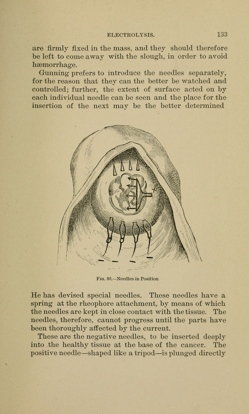 are firmly fixed in the mass, and they should therefore be left to come away with the slough, in order to avoid haemorrhage. Gunning prefers to introduce the needles separately, for the reason that they can the better be watched and controlled; further, the extent of surface acted on by each individual needle can be seen and the place for the insertion of the next may be the better determined Fig. I -Needles in Position He has devised special needles. These needles have a spring at the rheophore attachment, by means of which the needles are kept in close contact with the tissue. The needles, therefore, cannot progress until the parts have been thoroughly affected by the current. These are the negative needles, to be inserted deeply into the healthy tissue at the base of the cancer. The positive needle—shaped like a tripod—is plunged directly