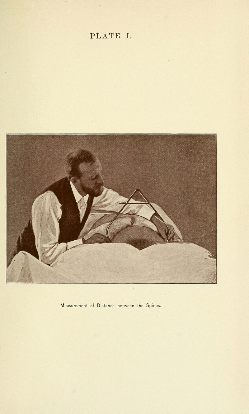 H fc_^.fe^jB 1 1 1 ■ ^^^^^^^^ T^^ g /MM I 1 H ^^^^P^ ri ^Kk^^ '^«l ^^^ / 'ig '^ ^ % » 1 2 —1^ ^^B »v ^ j^**- H ■■'5, ^^ ■ 1 I '■- mi^ - ^^HH BBp^' '*i^^^ ^ ' ^3 ■ • ' ' ■? Measurement of Distance between the Spines.