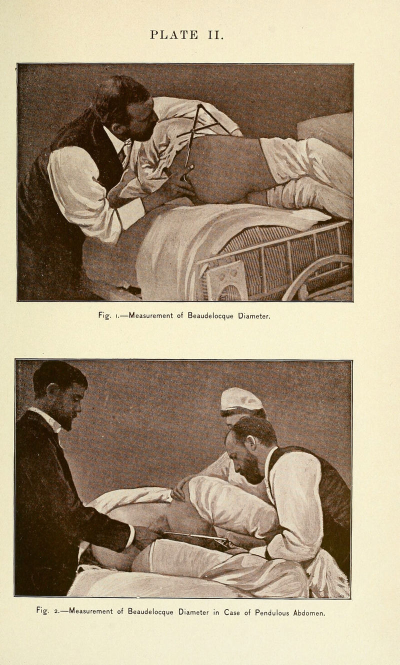 Fig. I.—Measurement of Beaudelocque Diameter. Fig. 2.—Measurement of Beaudelocque Diameter in Case of Pendulous Abdomen.