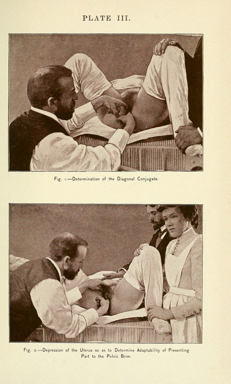 Fig. I.—Determination of the Diagonal Conjugate. Fig. 2.—Depression of the Uterus so as to Determine Adaptability of Presenting Part to the Pelvic Brim.