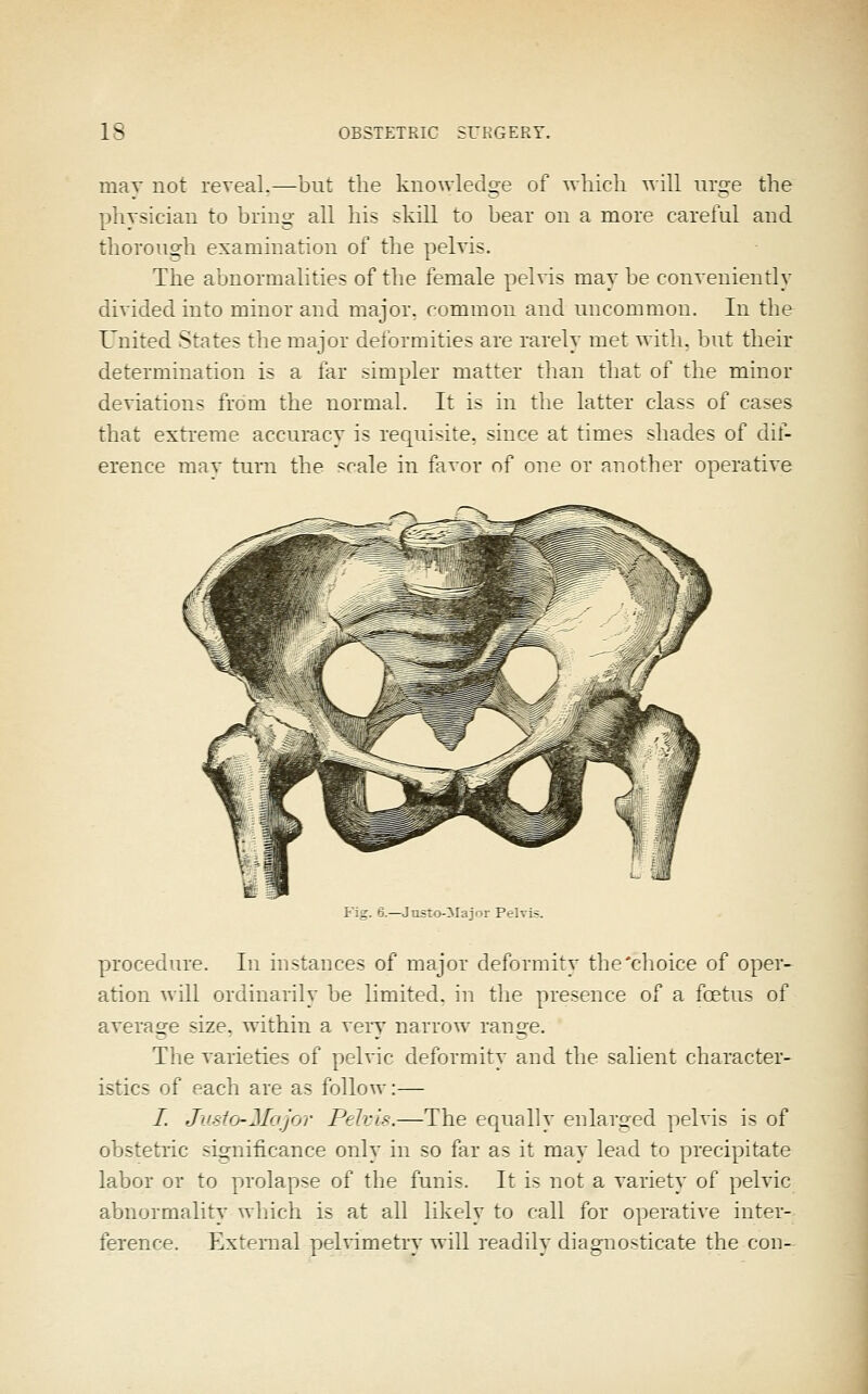 mav not reveal.—-but the knowledge of Avhicli ^vill nra-e the physician to brina' all his skill to bear on a more carei'ul and thorough examination of the pelvis. The abnormalities of tlie female pelvis may be conveniently divided into minor and major, cummon and uncommon. In the United States the major delormities are rarely met witli. l)ut their determination is a far simpler matter than that of the minor deviations from the normal. It i- in the latter class of cases that extreme accuracy is refpii>ire. since at times shades of dif- erence may turn the =rale in favor nf one or another operative Fig. 6.—^Justo-Major Pelvis. procedure. In instances of major deformity the'choice of oper- ation will ordinarily be limited, in tlie presence of a foetus of avera£:e size, within a very narrow ran2e. The varieties of pelvic deformitv and the salient character- istics of f-ach are as follow:— /. Jusio-Mojor Felc'i.^.—The ecpaaliy erdara'ed pelvis is of obstetric significance only in so far as it may lead to precipitate labor or to prolapse of the funis. It is not a variety of pelvic abnormality Avliich is at all likely to rail for operative inter- ference. Extfrrnal pjelvimetrv will readily diagnosticate the con-