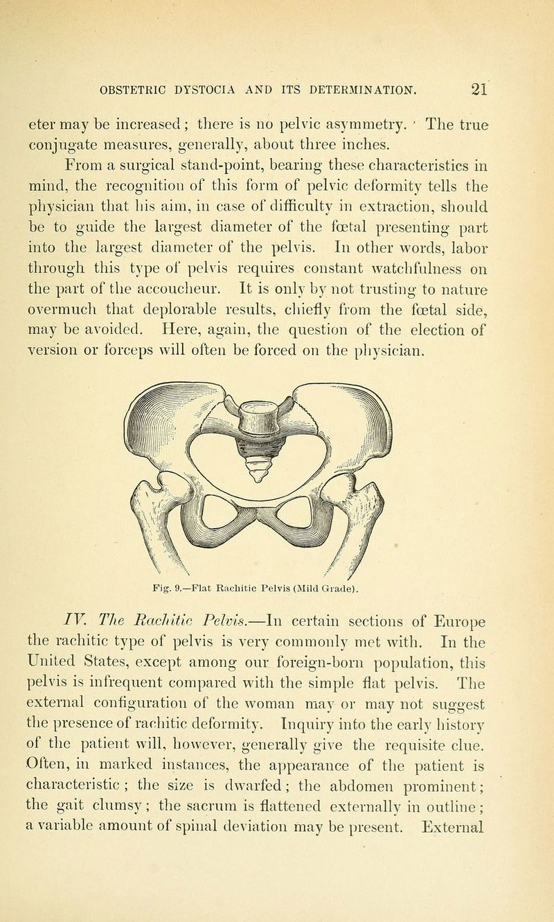 eter may be increased; there is no pelvic asymmetry. ' The true conjugate measures, generally, about three inches. From a surgical stand-point, bearing these characteristics in mind, the recognition of this form of pelvic deformity tells the physician that his aim, in case of difficulty in extraction, should be to guide the largest diameter of the fcetal presenting part into the largest diameter of the pelvis. In other words, labor through this type of pelvis requires constant watchfulness on the part of the accoucheur. It is only by not trusting to nature overmuch that deplorable results, chiefly from the foetal side, may be avoided. Here, again, the question of the election of version or forceps will often be forced on the physician. Pig. 9.—Flat Rachitic Pelvis (Mild Grade). IV. The Racliitic Pelvis.—In certain sections of Europe the rachitic type of pelvis is very commonly met with. In the United States, except among our foreign-born population, this pelvis is infrequent compared with the simple flat pelvis. The external conflguration of the woman may or may not suggest the presence of rachitic deformity. Inquiry into the early history of the patient will, however, generally give the requisite clue. Often, in marked instances, the appearance of the patient is characteristic ; the size is dwarfed; the abdomen prominent; the gait clumsy ; the sacrum is flattened externally in outline; a variable amount of spinal deviation may be present. External