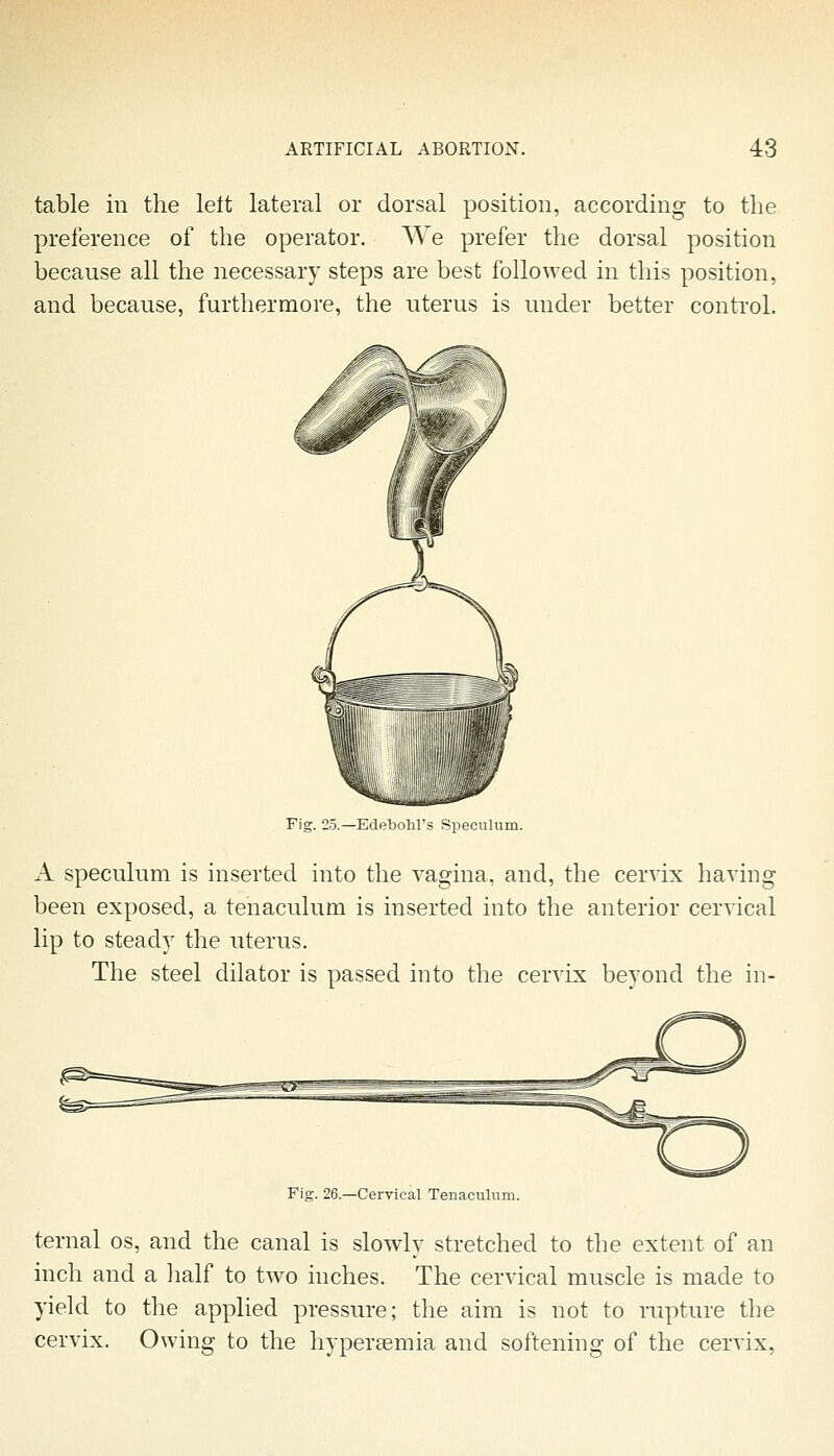 table in the lett lateral or dorsal position, according to the preference of the operator. We prefer the dorsal position because all the necessary steps are best followed in this position, and because, furthermore, the uterus is under better control. Fig. 25.—Edebolil's Speculum. A speculum is inserted into the vagina, and, the cervix having been exposed, a tenaculum is inserted into the anterior cervical lip to steady the uterus. The steel dilator is passed into the cervix beyond the in- Fig. 26.—Cervical Tenaculum. ternal os, and the canal is slowly stretched to the extent of an inch and a half to two inches. The cervical muscle is made to yield to the applied pressure; the aim is not to rupture the cervix. Owing to the hypersemia and softening of the cervix,