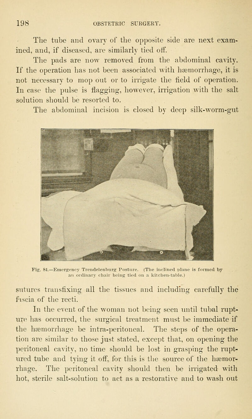 The tube and ovary of the opposite side are next exam- ined, and, if diseased, are similarly tied otf. The pads are now removed from the abdominal cavity. If the operation has not been associated with haemorrhage, it is not necessary to mop out or to irrigate the field of operation. In case the pulse is flagging, however, irrigation with the salt solution should be resorted to. The abdominal incision is closed by deep silk-worm-gut Fig. 84.—Emergency Trendelenburg Posture. (The inclined plane is formed by an ordinary chair being tied on a kitchen-table.) sutures transfixing all the tissues and including carefully the fascia of the recti. In the event of the woman not being seen until tubal rupt- ure has occurred, the surgical treatment must be immediate if the haemorrhage be intra-peritoneal. The steps of the opera- tion are similar to those just stated, except that, on opening the peritoneal cavity, no time should be lost in grasping the rupt- ured tube and tying it off, for tliis is tlie source of the haemor- rhage. The peritoneal cavity should then be irrigated with hot, sterile salt-solution to act as a restorative and to wash out