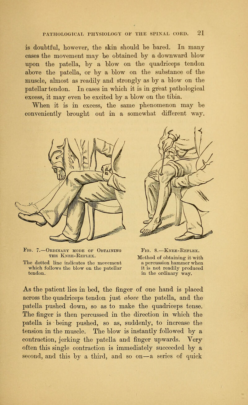 is doubtful, however, the skin should be bared. In many cases the movement may be obtained by a downward blow upon the patella, by a blow on the quadriceps tendon above the patella, or by a blow on the substance of the muscle, almost as readily and strongly as by a blow on the patellar tendon. In cases in which it is in great pathological excess, it may even be excited by a blow on the tibia. When it is in excess, the same phenomenon may be conveniently brought out in a somewhat different way. Fig. 7.—Obdinaky mode of Obtaining the Knee-Reflex. The dotted line indicates the movement which follows the blow on the patellar tendon. Fig. 8.—Knee-Reflex. Method of obtaining it with a percussion hammer when it is not readily produced in the ordinary way. As the patient lies in bed, the finger of one hand is placed across the quadriceps tendon just above the patella, and the patella pushed down, so as to make the quadriceps tense. The finger is then percussed in the direction in which the patella is - being pushed, so as, suddenly, to increase the tension in the muscle. The blow is instantly followed by a contraction, jerking the patella and finger upwards. Very often this single contraction is immediately succeeded by a second, and this by a third, and so on—a series of quick