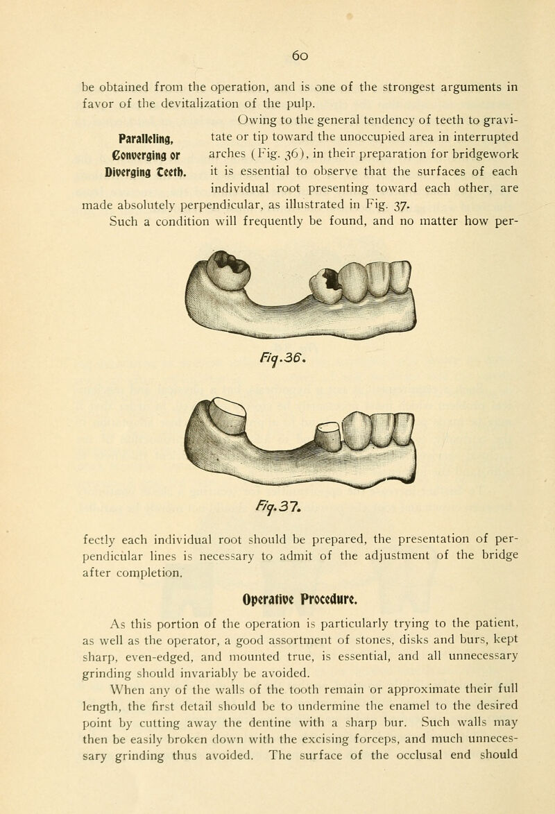 be obtained from the operation, and is one of the strongest arguments in favor of the devitalization of the pulp. Owing to the general tendency of teeth to gravi- Paralleling, tate or tip tov^ard the unoccupied area in interrupted Converging or arches (Fig. 36), in their preparation for bridgework Diverging Ccetb. it is essential to observe that the surfaces of each individual root presenting toward each other, are made absolutely perpendicular, as illustrated in Fig. 37. Such a condition wdll frequently be found, and no matter how per- Fitj.ae, fectly each individual root should be prepared, the presentation of per- pendicular lines is necessary to admit of the adjustment of the bridge after completion. Operative Procedure. As this portion of the operation is particularly trying to the patient, as well as the operator, a good assortment of stones, disks and burs, kept sharp, even-edged, and mounted true, is essential, and all unnecessary grinding should invariably be avoided. When any of the walls of the tooth remain or approximate their full length, the first detail should be to undermine the enamel to the desired point by cutting away the dentine with a sharp bur. Such walls may then be easily broken down with the excising forceps, and much unneces- sary grinding thus avoided. The surface of the occlusal end should