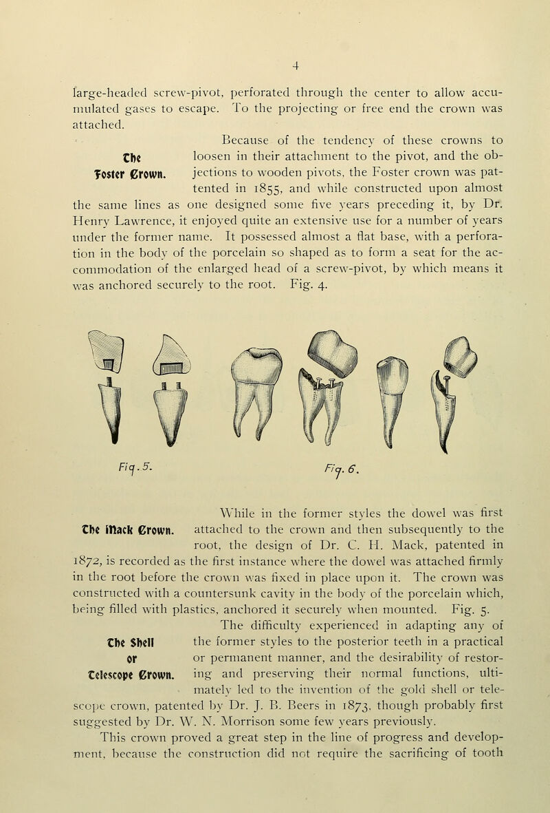 large-headed screw-pivot, perforated through the center to allow accu- mulated gases to escape. To the projecting or free end the crown was attached. Because of the tendency of these crowns to Cl)c loosen in their attachment to the pivot, and the ob- fOStcr €rown. jections to wooden pivots, the Foster crown was pat- tented in 1855, and while constructed upon almost the same lines as one designed some five years preceding it, by Dr. Henry Lawrence, it enjoyed quite an extensive use for a number of years under the former name. It possessed almost a flat base, with a perfora- tion in the body of the porcelain so shaped as to form a seat for the ac- commodation of the enlarged head of a screw-pivot, by which means it was anchored securely to the root. Fig. 4. Fic^ 5, F!j. 6. While in the former styles the dowel was first Cl)i JIlacR Crown. attached to the crown and then subsequently to the root, the design of Dr. C. H. Mack, patented in 1872, is recorded as the first instance where the dowel was attached firmly in the root before the crown was fixed in place upon it. The crown was constructed with a countersunk cavity in the body of the porcelain which, being filled with plastics, anchored it securely when mounted. Fig. 5. The difficulty experienced in adapting any of CbC Shell the former styles to the posterior teeth in a practical or or permanent manner, and the desirability of restor- Celescopt Crown. ing and preserving their normal functions, ulti- mately led to the invention of the gold shell or tele- scope crown, patented by Dr. J. B. Beers in 1873. though probably first suggested by Dr. W. N. Morrison some few years previously. This crown proved a great step in the line of progress and develop- ment, because the construction did not require the sacrificing of tooth