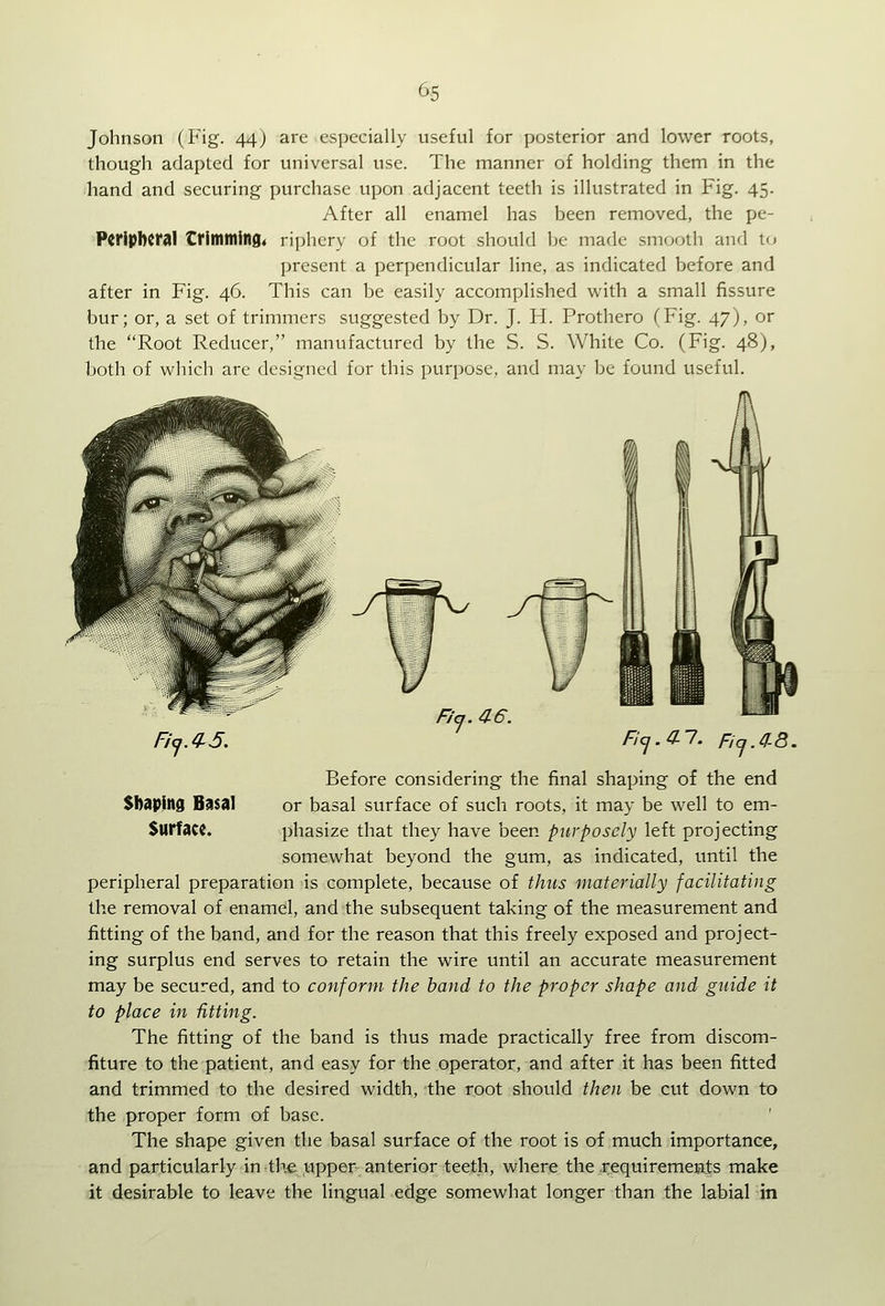 Johnson (Fig. 44) are especially useful for posterior and lower roots, though adapted for universal use. The manner of holding them in the hand and securing purchase upon adjacent teeth is illustrated in Fig. 45. After all enamel has been removed, the pe- PCfiphCral Crlltimlllfl* riphcry of the root should be made smooth and to present a perpendicular line, as indicated before and after in Fig. 46. This can be easily accomplished with a small fissure bur; or, a set of trimmers suggested by Dr. J. H. Prothero (Fig. 47), or the Root Reducer, manufactured by the S. S. White Co. (Fig. 48), both of which are designed for this purpose, and may be found useful. Fia. 0.6. Before considering the final shaping of the end Shaping Basal or basal surface of such roots, it may be well to em- Surface. phasize that they have been purposely left projecting somewhat beyond the gum, as indicated, until the peripheral preparation is complete, because of thus materially facilitating the removal of enamel, and the subsequent taking of the measurement and fitting of the band, and for the reason that this freely exposed and project- ing surplus end serves to retain the wire until an accurate measurement may be secured, and to conform the hand to the proper shape and guide it to place in fitting. The fitting of the band is thus made practically free from discom- fiture to the patient, and easy for the operator, and after it has been fitted and trimmed to the desired width, the root should then be cut down to the proper form of base. The shape given the basal surface of the root is of much importance, and particularly in the upper anterior teeth, where the requirements make it desirable to leave the lingual edge somewhat longer than the labial in