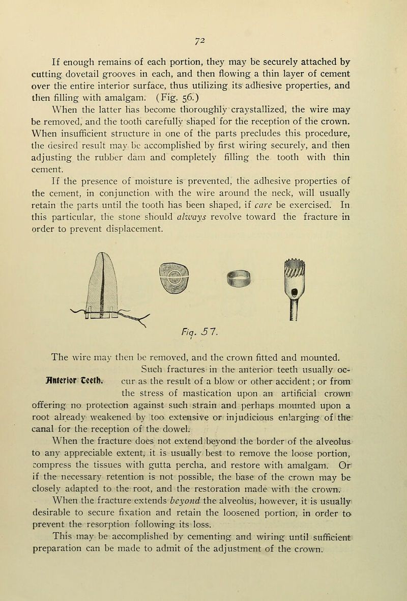 If enough remains of each portion, they may be securely attached by cutting dovetail grooves in each, and then flowing a thin layer of cement over the entire interior surface, thus utilizing its adhesive properties, and then filling with amalgam. (Fig. 56.) When the latter has become thoroughly craystallized, the wire may be removed, and the tooth carefully shaped for the reception of the crown. When insufficient structure in one of the parts precludes this procedure, the desired result may be accomplished by first wiring securely, and then adjusting the rubber dam and completely filling the tooth with thin cement. If the presence of moisture is prevented, the adhesive properties of the cement, in conjunction with the wire around the neck, will usually retain the parts until the tooth has been shaped, if care be exercised. In this particular, the stone should ahuays revolve toward the fracture in order to prevent displacement. Fiq. 51. The wire may then be removed, and the crown fitted and mounted. Such fractures in the anterior teeth usually oc- flntcrlor CCCtb. cur as the result of a blow or other accident; or from the stress of mastication upon an artificial crown offering no protection against such strain and perhaps mounted upon a root already weakened by too ext^isive or injudicious enlarging of the canal for the reception of the dowel. When the fracture does not extend b€;yond the border of the alveolus to any appreciable extent, it is usually best to remove the loose portion, compress the tissues with gutta percha, and restore with amalgam. Or if the necessary retention is not possible, the base of the crown may be closely adapted to the root, and the restoration made with the crown. When the fracture extends beyond the alveolus, however, it is usually desirable to secure fixation and retain the loosened portion, in order to prevent the resorption following its loss. This may be accomplished by cementing and wiring until sufficient preparation can be made to admit of the adjustment of the crown.