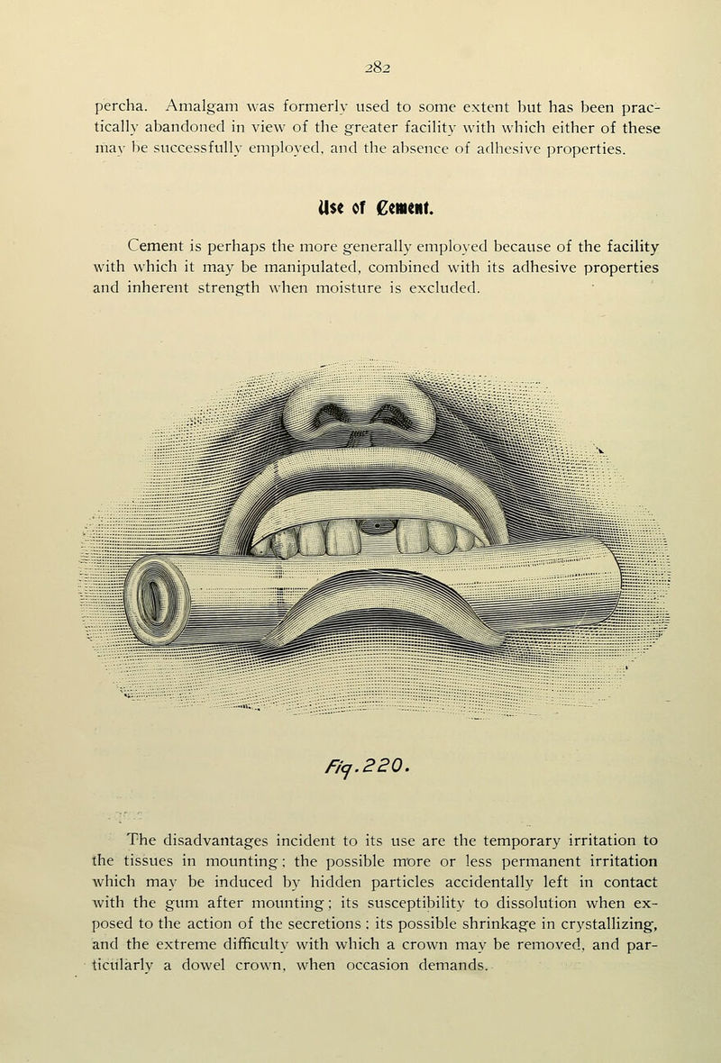 percha. Amalgam was formerly used to some extent but has been prac- tically abandoned in view of the greater facility with which either of these may be successfully employed, and the absence of adhesive properties. Use of Cement Cement is perhaps the more generally employed because of the facility with which it may be manipulated, combined with its adhesive properties and inherent strength when moisture is excluded. Fi<j.220, The disadvantages incident to its use are the temporary irritation to the tissues in mounting; the possible m*ore or less permanent irritation which may be induced by hidden particles accidentally left in contact with the gum after motinting; its susceptibility to dissolution when ex- posed to the action of the secretions; its possible shrinkage in crystallizing, and the extreme difficulty with which a crown may be removed, and par- ticularly a dowel crown, when occasion demands.