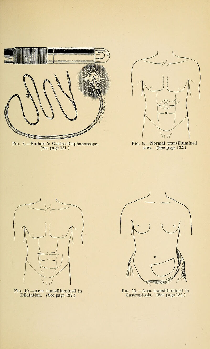 Fig. 8.—Einhorn's Gastro-Diaphanoscope. (Seepage 131.) Fig. 9.—Normal transillumined area. (See page 132.) Fig. 10.—Area transillumined in Dilatation. (See page 132.) Fig. 11.—Area transillumined In Gastroptosis. (See page 132.)