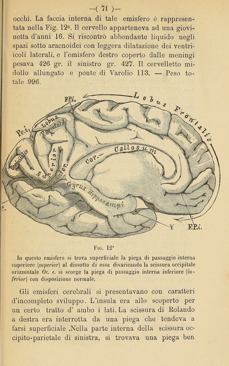 occhi. La faccia interna di tale emisfero è rappresen- tata nella Fig. 12^. Il cervello apparteneva ad una giovi- netta d'anni 16. Si riscontrò abbondante liquido negli spazi sotto aracnoidei con leggera dilatazione dei ventri- icoli laterali, e l'emisfero destro coperto dalle meningi pesava 426 gr. il sinistro gr. 427. Il cervelletto mi- dollo allungato e ponte di Varolio 113. — Peso to- tale 996. mi. FiG. W In questo emisfero si trova superficiale la piega di passaggio interna superiore [superior] al dissotto di essa divaricando la scissura occipitale orizzontale Oc. e. si scorge la piega di passaggio interna inferiore [in- ferior] con disposizione normale. Gli emisferi cerebrali si presentavano con caratteri d'incompleto sviluppo. L'insula era allo scoperto per un certo tratto d' ambo i lati. La scissura di Rolando a destra era interrotta da una piega che tendeva a farsi superficiale .Nella parte interna della scissura oc-