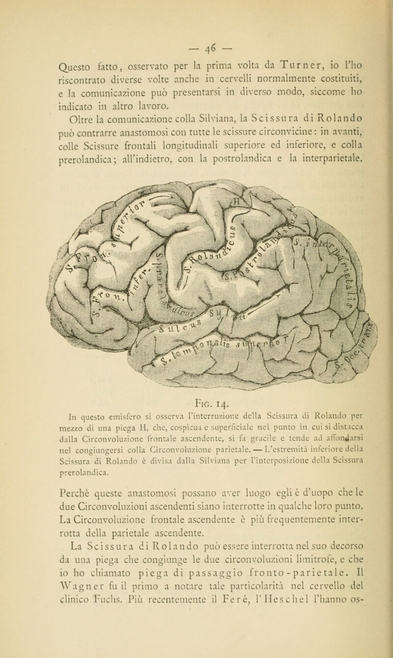 Questo fatto, osservato per la prima volta da Turner, io l'ho riscontrato diverse volte anche in cervelli normalmente costituiti, e la comunicazione può presentarsi in diverso modo, siccome ho indicato in altro lavoro. Oltre la comunicazione colla Silviana, la Scissura di Rolando può contrarre anastomosi con tutte le scissure circonvicine : in avanti, colle Scissure frontali longitudinali superiore ed inferiore, e colla prerolandica ; all'indietro, con la postrolandica e la interparietale. J%- Fig. 14. In questo emisfero si osserva l'interruzione della Scissura di Rolando per mezzo di una piega H, che, cospicua e superficiale nel punto in cui si distacca dalla Circonvoluzione frontale ascendente, si fa gracile e tende ad affondarsi nel congiungersi colla Circonvoluzione parietale. — L'estremità inferiore della Scissura di Rolando è divisa dalla Silviana per l'interposizione della Scissura prerolandica. Perchè queste anastomosi possano aver luogo egli è d'uopo che le due Circonvoluzioni ascendenti siano interrotte in qualche loro punto. La Circonvoluzione frontale ascendente è più frequentemente inter- rotta della parietale ascendente. La Scissura di Rolando può essere interrotta nel suo decorso da una piega che congiunge le due circonvoluzioni limitrofe, e che io ho chiamato piega di passaggio fronto - parie tale. Il Wagner fu il primo a notare tale particolarità nel cervello del clinico Luchs. Più recentemente il Fere, l'IIeschel l'hanno os-