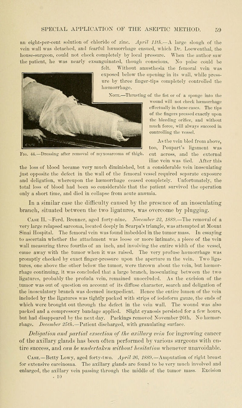 44.—Dressiuff after removal of myxosarcoma of thigh. an eight-per-cent solution of chloride of zinc. Ajyril llfh.—A large slough of the vein wall was detached, and fearful haemorrhage ensued, which Dr. Loewenthal, the house-surgeon, could not check completely by local pressure. When the author saw the patient, he was nearly exsanguinated, though conscious. ISTo pulse could he felt. Without anesthesia the femoral vein was exposed below the opening in its wall, while press- ure by three finger-tips completely controlled the htemorrhage. of the iist or of a sponge into the wound will not check hemorrhage effectually in these cases. The tips of the fingers pressed exactly upon the bleeding orifice, and without much force, will always succeed in controlling the vessel. As the vein bled from above, too, Poupart's ligament was cut across, and the external iliac vein was tied. After this the loss of blood became very much diminished, but a considerable vein inosculating just opposite the defect in the wall of the femoral vessel required separate exposure and deligation, whereupon the haemorrhage ceased completely. Unfortunately, the total loss of blood had been so considerable that the patient survived the operation only a short time, and died in collapse from acute anaemia. In a similar case the difficulty caused by tlie presence of an inosculating branch, situated between the two ligatures, was overcome by plugging. Case II. ^Ferd. Brenner, aged forty-nine. Noteviber 22, 1889.—The removal of a very large relapsed sarcoma, located deeply in Scarpa's triangle, was attempted at Mount Sinai Hospital. The femoral vein was found imbedded in the tumor mass. In essaying to ascertain whether the attachment was loose or more intimate, a piece of the vein wall measuring three fourths of an inch, and involving the entire width of the vessel, came away with the tumor when it was raised. The very profuse hfemorrhage was promptly checked by exact finger-pressure upon the aperture m the vein. Two liga- tures, one above the other below the tumor, were thrown about the vein, but hseraor- rhage continuing, it was concluded that a large branch, inosculating between the two ligatures, probably the profuda vein, remained unoccluded. As the excision of the tumor was out of question on account of its diffuse character, search and deligation of the inosculatory branch was deemed inexpedient. Hence the entire lumen of the vein included by the ligatures was tightly packed with strips of iodoform gauze, the ends of which were brought out through the defect in the vein wall. The wound was also packed and a compressory bandage applied. Slight cyanosis persisted for a few hours, but had disappeared by the next day. Packings removed November 26th. No hfemor- rhage. December 25tJi.—Patient discharged, with granulating surface. Deligation and imrtial exsection of the axillary vein for ingrowing cancer of the axillary glands has been often performed by various surgeons with en- tire success, and can he undertahen without hesitation whenever unavoidable. Case.—Betty Lowy, aged forty-two. Ajjril 26, 1889.—Amputation of right breast for extensive carcinoma. The axillary glands are found to be very much involved and enlarged, the axillary vein passing through the middle of the tumor mass. Excision . 10