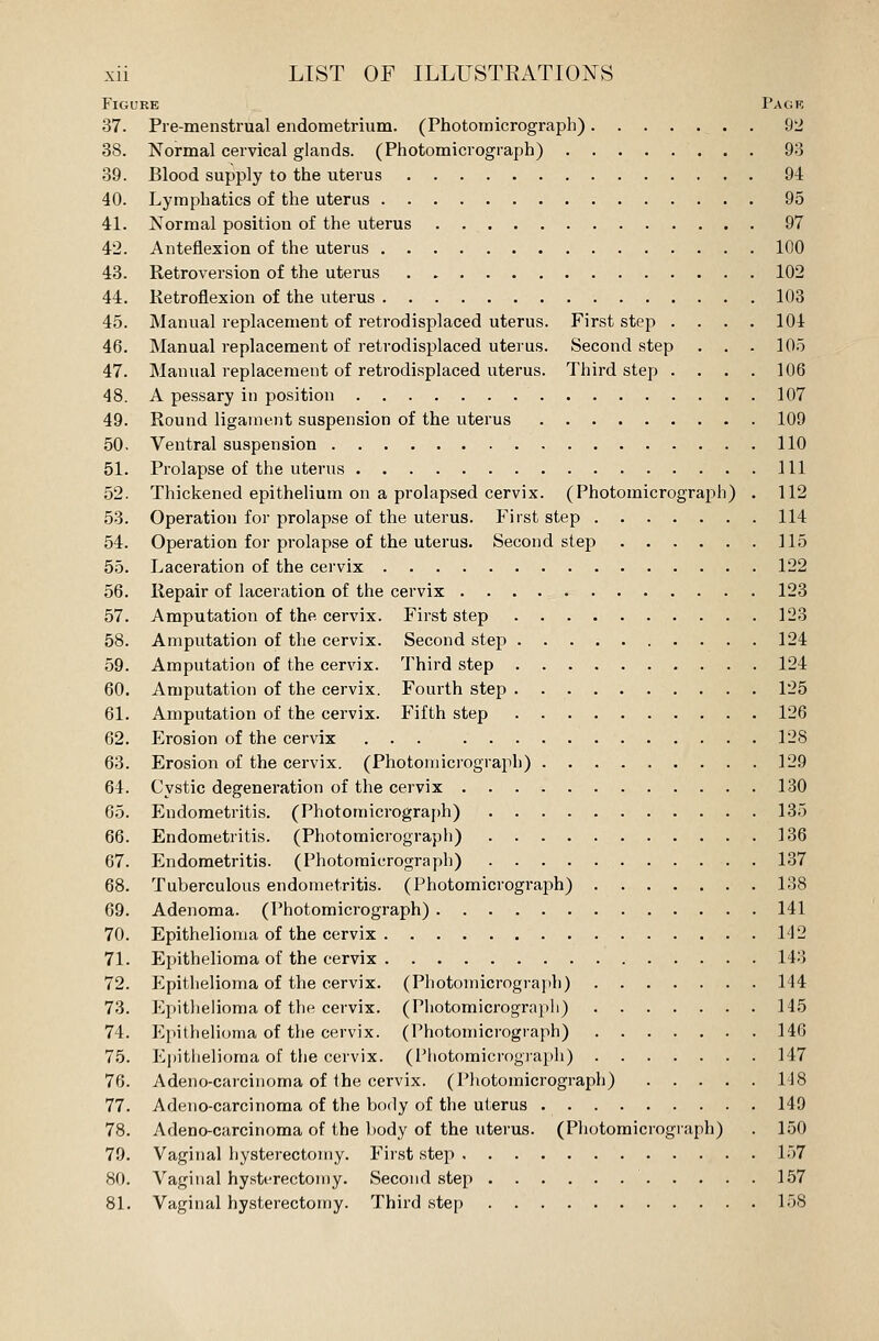 Figure Page 37. Pie-menstrual endometrium. (Photomicrograph) 92 38. Normal cervical glands. (Photomicrograph) 93 39. Blood supply to the uterus 94 40. Lymphatics of the uterus 95 41. Normal position of the uterus . . 97 42. Anteflexion of the uterus 100 43. Retroversion of the uterus 102 44. Retroflexion of the uterus 103 45. Manual replacement of retrodisplaced uterus. First step . . . . 104 46. Manual replacement of retrodisplaced uterus. Second step . . . 105 47. Manual replacement of retrodisplaced uterus. Third step .... 106 48. A pessary in position 107 49. Round ligament suspension of the uterus 109 50. Ventral suspension 110 51. Prolapse of the uterus Ill 52. Thickened epithelium on a prolapsed cervix. (Photomicrograph) . 112 53. Operation for prolapse of the uterus. First step 114 54. Operation for prolapse of the uterus. Second step 115 55. Laceration of the cervix 122 56. Repair of laceration of the cervix 123 57. Amputation of the cervix. First step 123 58. Amputation of the cervix. Second step 124 59. Amputation of the cervix. Third step 124 60. Amputation of the cervix. Fourth step 125 61. Amputation of the cervix. Fifth step 126 62. Erosion of the cervix 128 63. Erosion of the cervix. (Photomicrograph) 129 64. Cystic degeneration of the cervix 130 65. Endometritis. (Photomicrograph) 135 66. Endometritis. (Photomicrograph) 136 67. Endometritis. (Photomicrograph) 137 68. Tuberculous endometritis. (Photomicrograph) 138 69. Adenoma. (Photomicrograph) 141 70. Epithelioma of the cervix 142 71. Epithelioma of the cervix 143 72. Epithelioma of the cervix. (Photomicrograph) 144 73. Epithelioma of the cervix. (Photomicrograph) 145 74. Epithelioma of the cervix. (Photomicrograph) 146 75. Epithelioma of the cervix. (Photomicrograph) 147 76. Adeno-carcinoma of the cervix. (Photomicrograph) 118 77. Adeno-carcinoma of the body of the uterus 149 78. Adeno-carcinoma of the body of the uterus. (Photomicrograph) . 150 79. Vaginal hysterectomy. First step 157 80. Vaginal hysterectomy. Second step 157 81. Vaginal hysterectomy. Third step 158