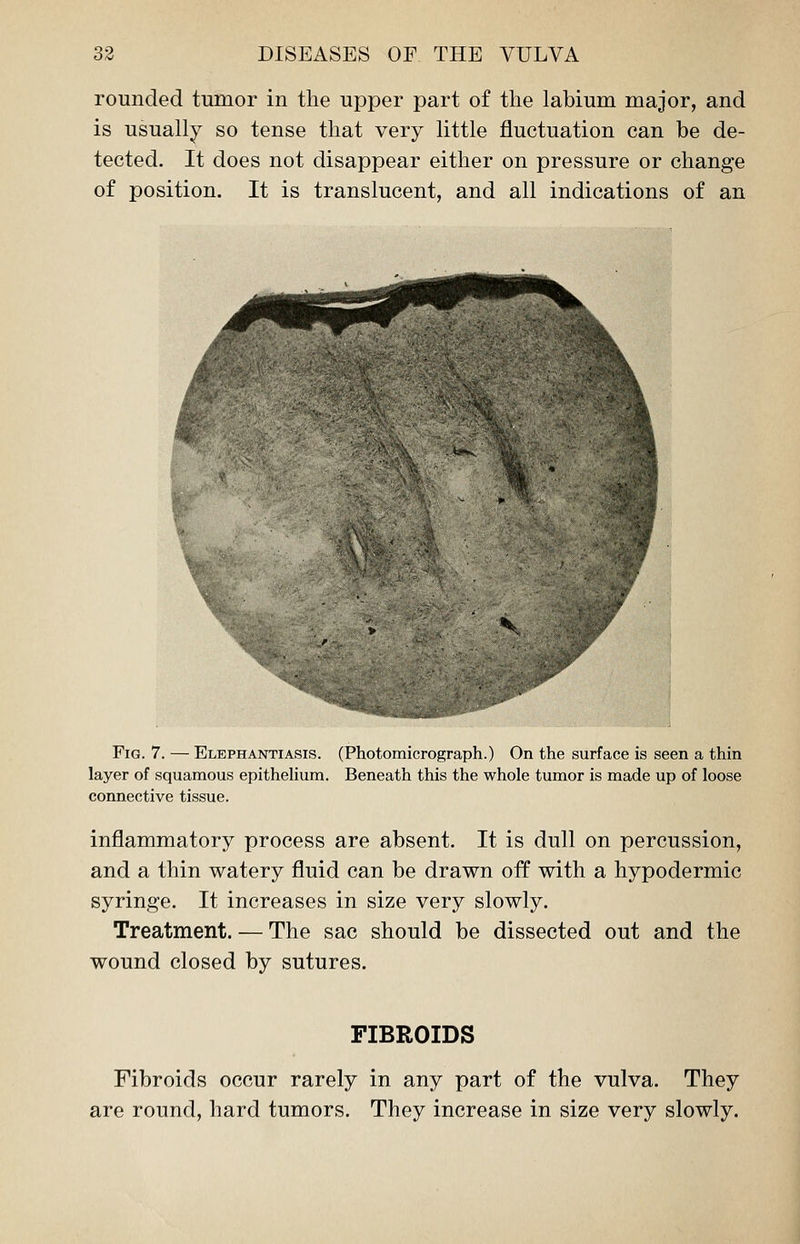rounded tumor in the upper part of the labium major, and is usually so tense that very little fluctuation can be de- tected. It does not disappear either on pressure or change of position. It is translucent, and all indications of an * Fig. 7. — Elephantiasis. (Photomicrograph.) On the surface is seen a thin layer of squamous epithelium. Beneath this the whole tumor is made up of loose connective tissue. inflammatory process are absent. It is dull on percussion, and a thin watery fluid can be drawn off with a hypodermic syringe. It increases in size very slowly. Treatment. — The sac should be dissected out and the wound closed by sutures. FIBROIDS Fibroids occur rarely in any part of the vulva. They are round, hard tumors. They increase in size very slowly.