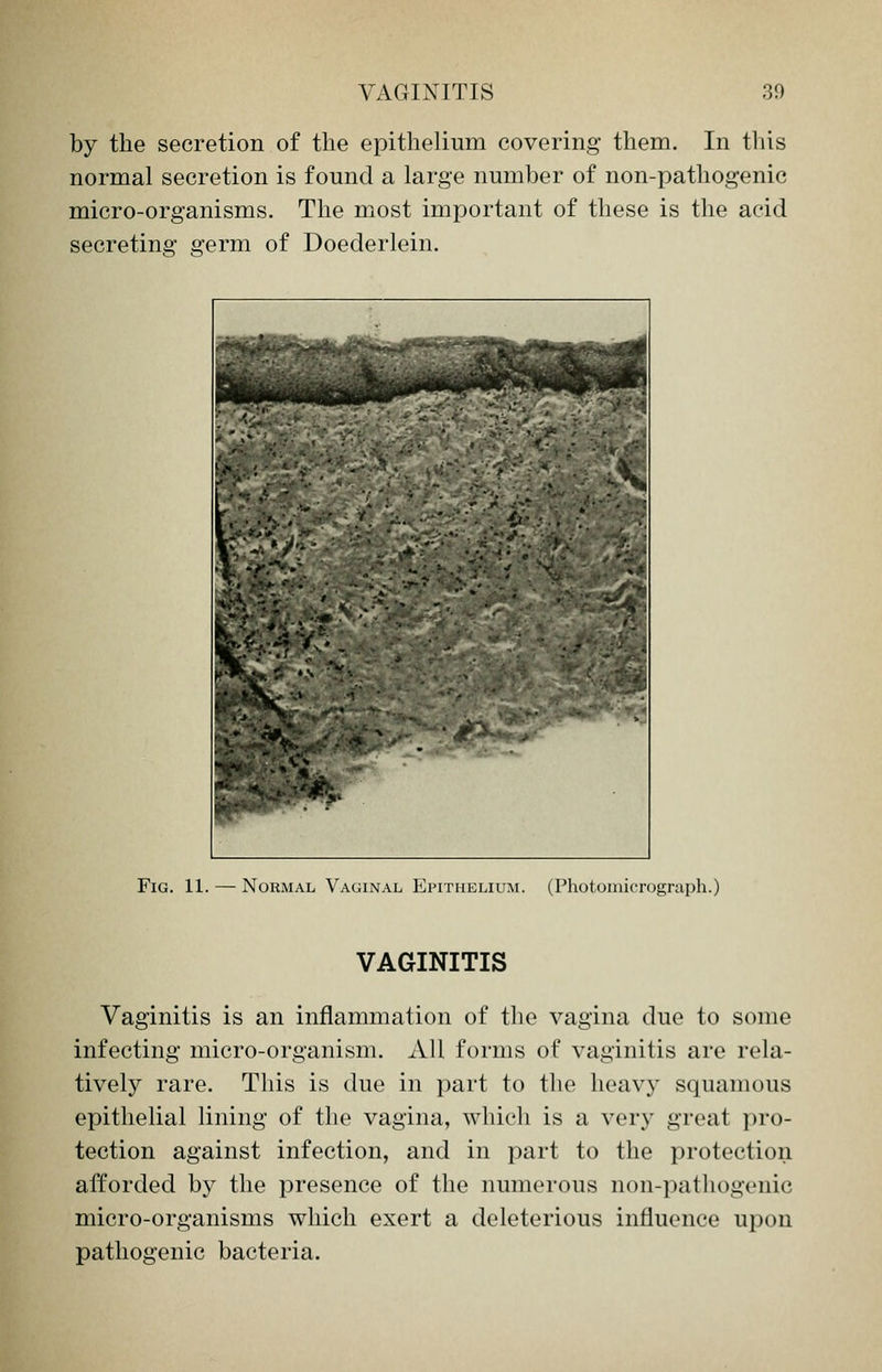 by the secretion of the epithelium covering them. In this normal secretion is found a large number of non-pathogenic micro-organisms. The most important of these is the acid secreting germ of Doederlein. ■ Fig. 11. — Normal Vaginal Epithelium. (Photomicrograph.) VAGINITIS Vaginitis is an inflammation of the vagina due to some infecting micro-organism. All forms of vaginitis are rela- tively rare. This is due in part to the heavy squamous epithelial lining of the vagina, which is a very great pro- tection against infection, and in part to the protection afforded by the presence of the numerous non-pathogenic micro-organisms which exert a deleterious influence upon pathogenic bacteria.