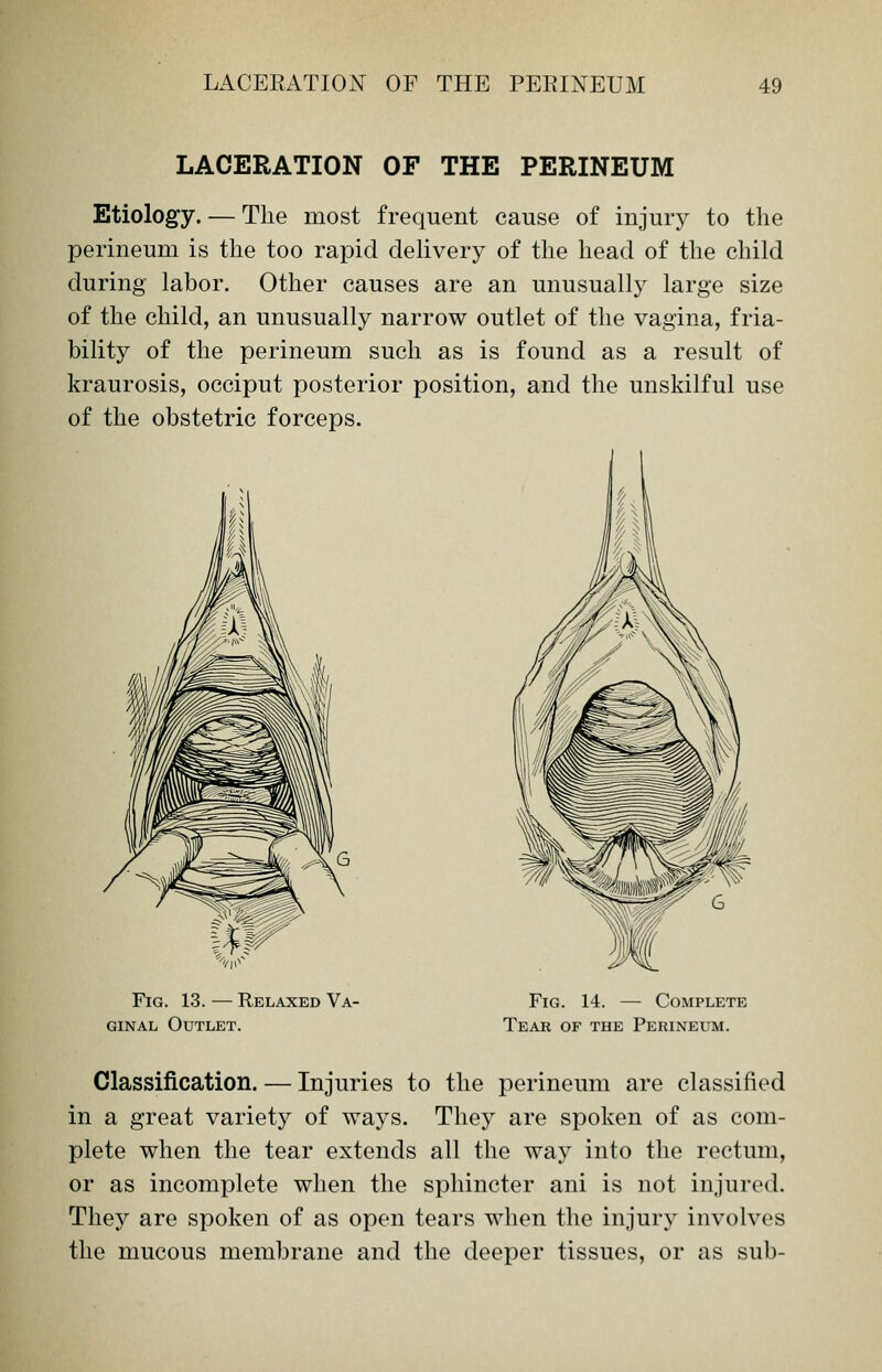 LACERATION OF THE PERINEUM Etiology. — The most frequent cause of injury to the perineum is the too rapid delivery of the head of the child during labor. Other causes are an unusually large size of the child, an unusually narrow outlet of the vagina, fria- bility of the perineum such as is found as a result of kraurosis, occiput posterior position, and the unskilful use of the obstetric forceps. Fig. 13. — Relaxed Va- ginal Outlet. Fig. 14. — Complete Tear of the Perineum. Classification. — Injuries to the perineum are classified in a great variety of ways. They are spoken of as com- plete when the tear extends all the way into the rectum, or as incomplete when the sphincter ani is not injured. They are spoken of as open tears when the injury involves the mucous membrane and the deeper tissues, or as sub-