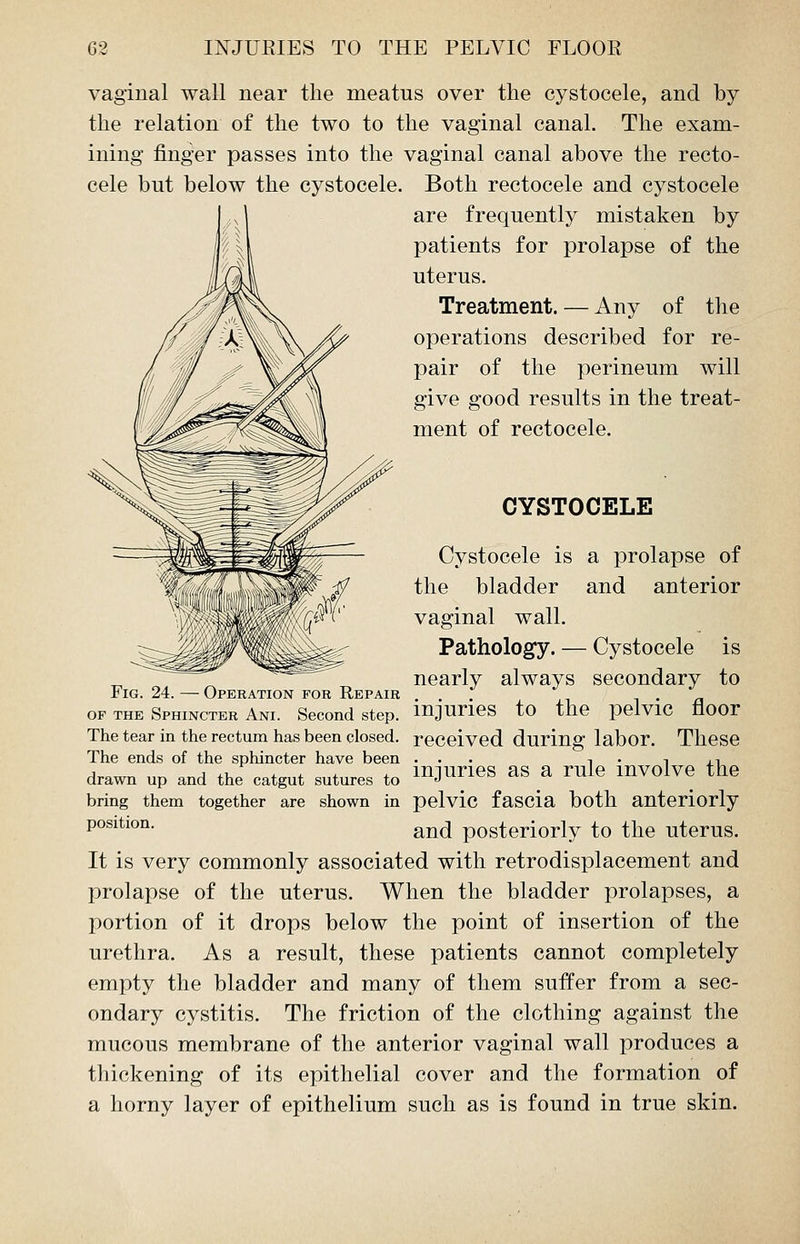vaginal wall near the meatus over the cystocele, and by the relation of the two to the vaginal canal. The exam- ining finger passes into the vaginal canal above the recto- cele but below the cystocele. Both rectocele and cystocele are frequently mistaken by patients for prolapse of the uterus. Treatment. — Any of the operations described for re- pair of the perineum will give good results in the treat- ment of rectocele. CYSTOCELE Cystocele is a prolapse of the bladder and anterior vaginal wall. Pathology. — Cystocele is nearly always secondary to Fig. 24. — Operation for Repair . of the Sphincter Ani. Second step, injuries to the pelvic floor The tear in the rectum has been closed, received during labor. These The ends of the sphincter have been ... -. . -. ,-. drawn up and the catgut sutures to juries ™ a rule involve the bring them together are shown in pelvic fascia both anteriorly position. an(j pOSteriorly to the uterus. It is very commonly associated with retrodisplacement and prolapse of the uterus. When the bladder prolapses, a portion of it drops below the point of insertion of the urethra. As a result, these patients cannot completely empty the bladder and many of them suffer from a sec- ondary cystitis. The friction of the clothing against the mucous membrane of the anterior vaginal wall produces a thickening of its epithelial cover and the formation of a horny layer of epithelium such as is found in true skin.