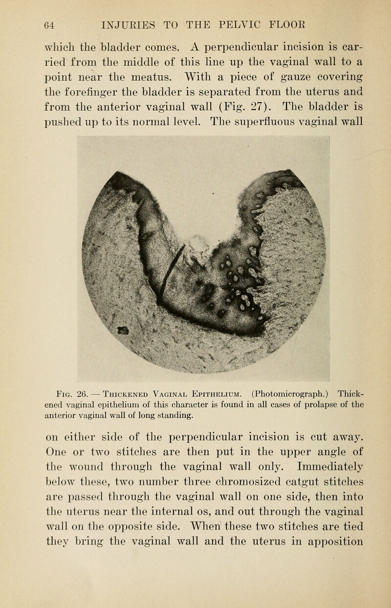 which the bladder comes. A perpendicular incision is car- ried from the middle of this line up the vaginal wall to a point near the meatus. With a piece of gauze covering the forefinger the bladder is separated from the uterus and from the anterior vaginal wall (Fig. 27). The bladder is pushed up to its normal level. The superfluous vaginal wall Fig. 26. — Thickened Vaginal Epithelium. (Photomicrograph.) Thick- ened vaginal epithelium of this character is found in all cases of prolapse of the anterior vaginal wall of long standing. on either side of the perpendicular incision is cut away. One or two stitches are then put in the upper angle of the wound through the vaginal wall only. Immediately below these, two number three chromosized catgut stitches are passed through the vaginal wall on one side, then into the uterus near the internal os, and out through the vaginal wall on the opposite side. When these two stitches are tied they bring the vaginal wall and the uterus in apposition