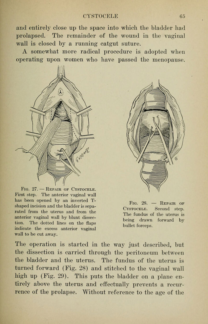 and entirely close up the space into which the bladder had prolapsed. The remainder of the wound in the vaginal wall is closed by a running catgut suture. A somewhat more radical procedure is adopted when operating upon women who have passed the menopause. Fig. 27. — Repair of Cystocele. First step. The anterior vaginal wall has been opened by an inverted T- shaped incision and the bladder is sepa- rated from the uterus and from the anterior vaginal wall by blunt dissec- tion. The dotted lines on the flaps indicate the excess anterior vaginal wall to be cut away. Fig. 28. — Repair of Cystocele. Second step. The fundus of the uterus is being drawn forward by bullet forceps. The operation is started in the way just described, but the dissection is carried through the peritoneum between the bladder and the uterus. The fundus of the uterus is turned forward (Fig. 28) and stitched to the vaginal wall high up (Fig. 29). This puts the bladder on a plane en- tirely above the uterus and effectually prevents a recur- rence of the prolapse. Without reference to the age of the