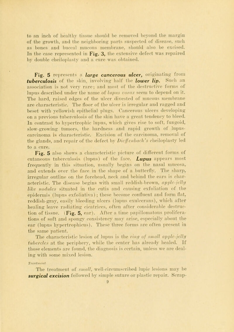 to an inch of lienltliy tissue sliould he removed heyond the margin of tlie growtli, and tlie n('i,u:hl)orin.u- i^irts suspected of disease, such as hones and huccal mucous meml)rane, sliould also he excised. In the case represented in Fig. 3, the extensive defect was repaired by douhle clieilo])lasty aiiil a cure was ohtained. Fig. 5 rcprofiils a large cancerous ulcer, niiij:iiiatin,i,' t rom tuberculosis of the skin, iinolvin.e; half the lower lip. Such an association is not very rare; and most of the destructive forms of lupus described under the name of lupus vorox seem to depend on it. The hard, raised edjjes of the ulcer divested of mucous membrane are characteristic. The floor of the ulcer is irregular and ragged and beset Avith yellowish epithelial plugs. Cancerous ulcers developing on a previous tulierculosis of the skin have a great tendency to bleed. In contrast to hypertrophic lupus, which gives rise to soft, fungoid, slow-growing tumors, the hardness and rapid growth of Inpus- carcinoma is characteristic. Excision of the carcinoma, removal of the glands, and rejiair of the defect by Dicffciiharli's cheiloplasty led to a cure. Fig. 5 also shows a charactoiistii' jucture of different forms of cutaneous tuberculosis (lupus) of the face. Lupus appears most frequently in this situation, usually begins on the nasal mucosa,, and extends over the face in the shape of a butterfly. The sharp, irregular outline on the forehead, neck and behind the ears is char- acteristic. The disease begins with small reddish-brown, opple-jcUi/ like nodules situated in the cutis and causing exfoliation of the epidermis (lupus exfoliativa); these become confluent and form flat, reddish-gray, easily bleeding ulcers (lupus exulcerans), which after healing leave radiating cicatrices, often after considerable destruc- tion of tissue. (Fig. 5, ear). After a time papillomatous jirolifera- tions of soft and spongy consistency may arise, especially about the ear (lupus hypertrophieus). These three forms are often present in the same patient. The characteristic lesion of lupus i> the liiir/ of sniall apple-jcUf/ tubercles at the i)eriphery, while the center has already healed. If tho.se elements are found, the diagnosis is certain, unless we are deal- ing with some mixed lesion. Tieiitmail The treatment of siikiU, wcll-circumscrilied lupic lesions may be surgical excision followed by simple suture or plastic repair. 8crap-