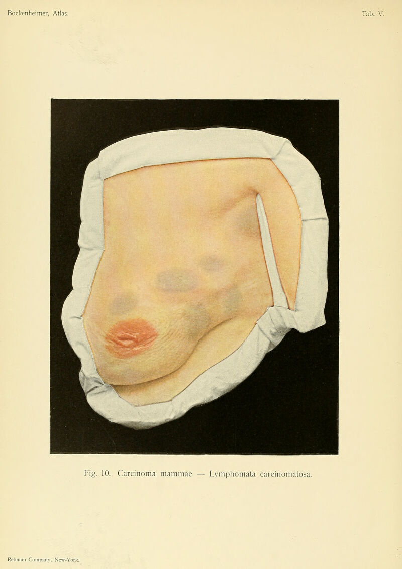 Fig. 10. Carcinoma mammae — Lympliomata carcinomatosa.