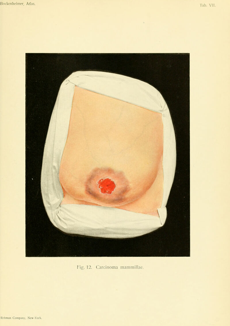 I^nrkcnlipiincr, Atlas. Iitr. 12. Carcinoma maiiiiiiillac. Ri'lnii.iii Comp.iiiy, Ncw-\'ork.