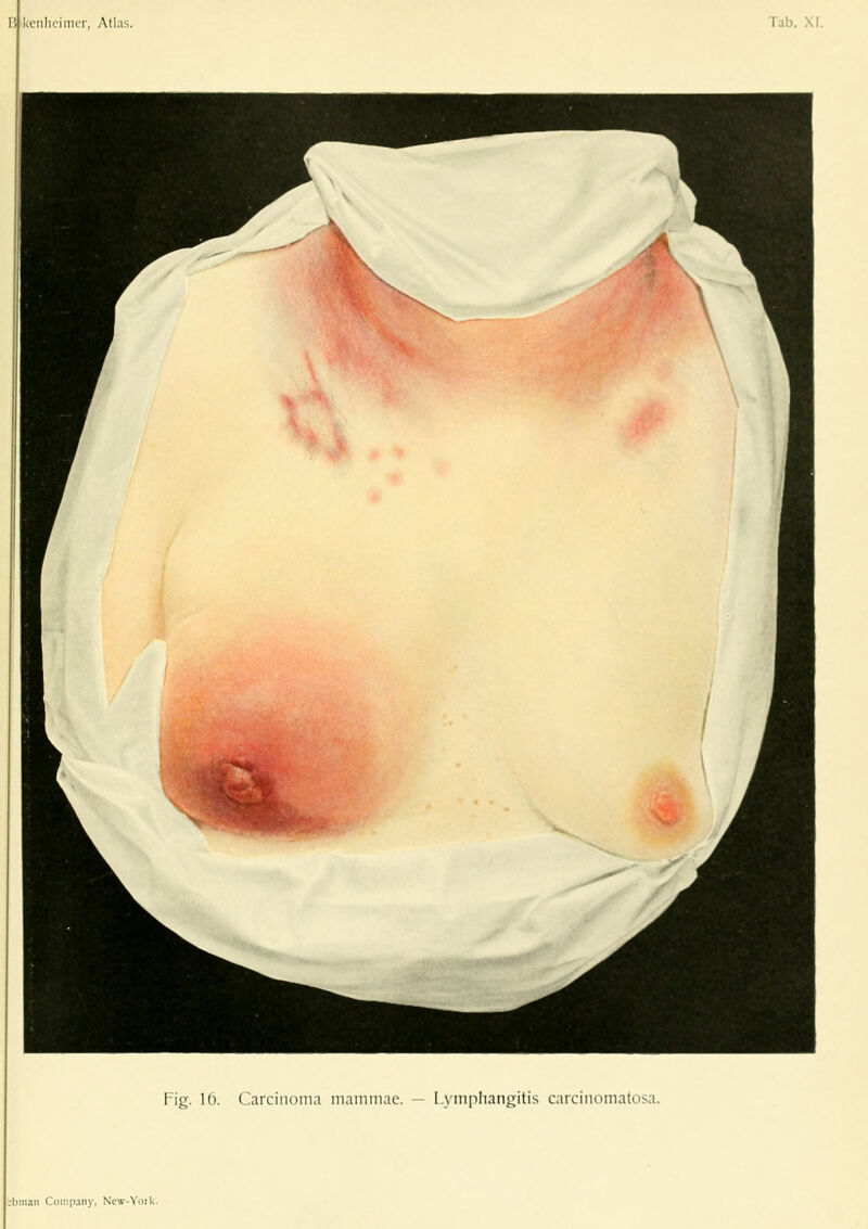 % Fig. 16. Carcinoma mammae. — Lymphangitis carcinomatosa. :bnian CoTuiiaiiy, Ncw-Yoik.