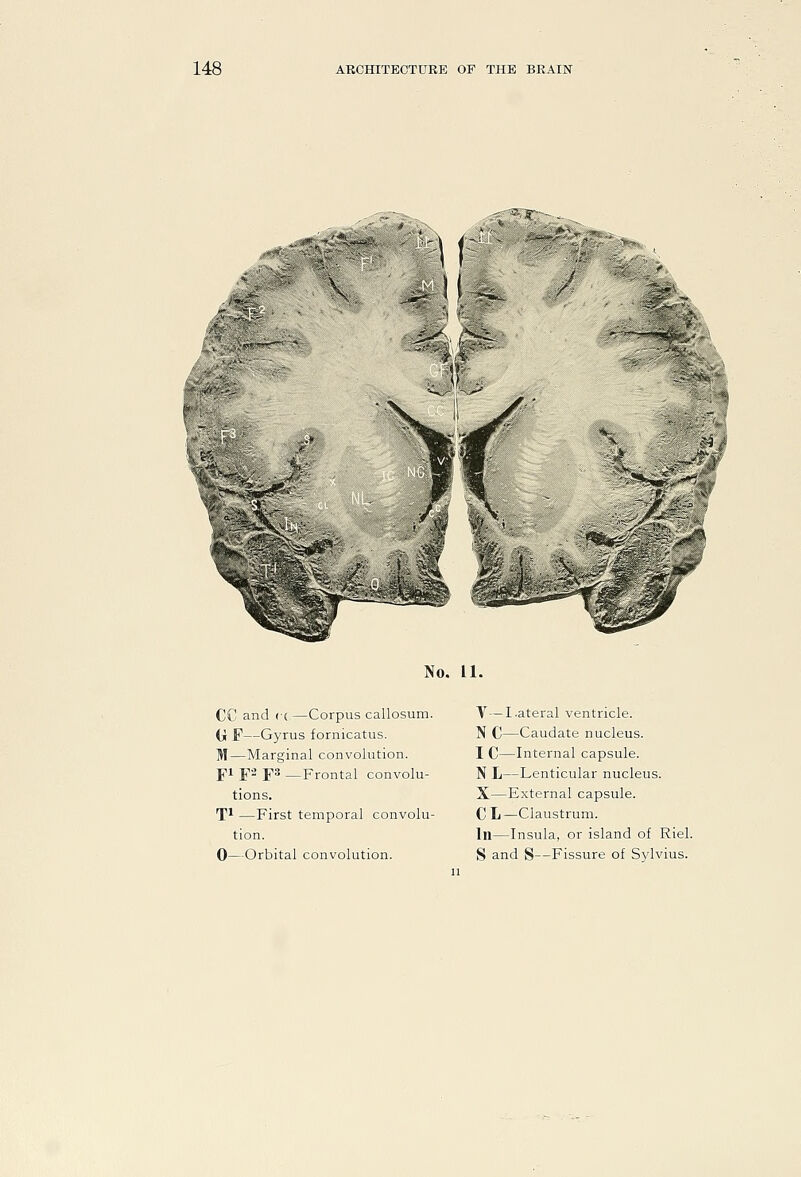 No. 11. CC and (•( —Corpus callosum. a P—Gyrus fornicatus. M—Marginal convolution. pi F^ F* —Frontal convolu- tions. T^ —First temporal convolu- tion. V—Lateral ventricle. N C—Caudate nucleus. I C—Internal capsule. N L—Lenticular nucleus. X—External capsule. C L—Claustrum. In—Insula, or island of Riel.