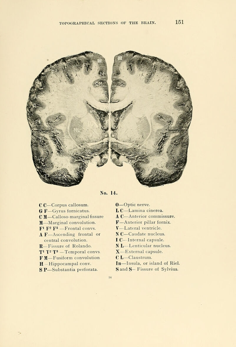No. 14. C C—Corpus callosum. G F—Gyrus fornicatus. C M—Calloso-marginal fissure M—-Marginal convolution. fi pa ps —Frontal convs. A F—Ascending frontal or central convolution. R—Fissure of Rolando. rpi X^ T* —Temporal convs. F M—Fusiform convolution H — Hippocampal conv. 0—Optic nerve. L C—Lamina cinerea. A C—Anterior commissure. F—Anterior pillar fornix. V—Lateral ventricle. N C—Caudate nucleus. I C—-Internal capsule. N L—Lenticular nucleus. X—External capsule. C L—Claustrum. In—Insula, or island of Riel.