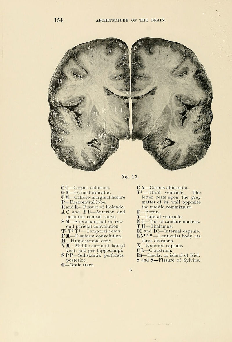 No. 17. CC—Corpus callosum. G F—Gyrus fornicatus. CM—Calloso-marginal fissure P—Paracentral lobe. RandR—Fissure of Rolando. AC and PC—Anterior and posterior central convs. S M—Supramarginal or sec- ond parietal convolution. iji fS fj^s —Temporal convs. FM—Fusiform convolution. H—Hippocampal conv. VM - Middle cornu of lateral vent, and pes hippocampi. SPP—Substantia perforata 0—Optic tract. C A—Corpus albicantia. T* —Third ventricle. The letter rests upon the grey matter of its wall opposite the middle commissure. F—Fornix. V—Lateral ventricle. N C—Tail of caudate nucleus. T H—Thalam.us. IC and IC—Internal capsule. LN^ 2 3 —Lenticular body; its three divisions. X—External capsule. C L—Claustrum. In—Insula, or island of Riel.