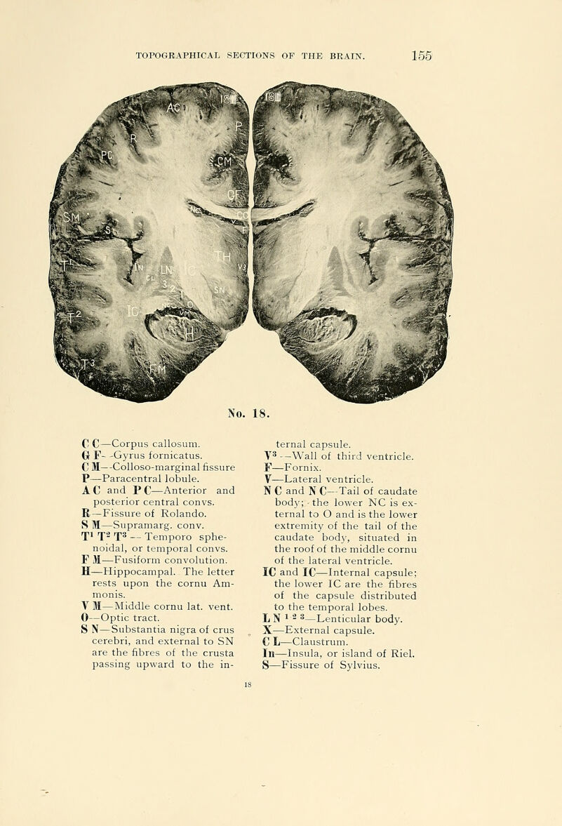 No. 18. CI C—Corpus callosum. G F- -Gyrus fornicatus. C M—Colloso-marginal fissure P—Paracentral lobule. AC and PC—Anterior and posterior central convs. R—Fissure of Rolando. S M—Supramarg. conv. rpi rj2 rps — Tempore sphe- noidal, or temporal convs. F M—Fusiform convolution. H—Hippocampal. The letter rests upon the cornu Am- monis. V M—Middle cornu lat. vent. 0—Optic tract. S N—Substantia nigra of crus cerebri, and external to SN are the fibres of the crusta ternal capsule. V^--Wall of third ventricle. F—Fornix. y—Lateral ventricle. N C and N C—Tail of caudate bod}'; • the lower NC is ex- ternal to O and is the lower extremity of the tail of the caudate body, situated in the roof of the middle cornu of the lateral ventricle. IC and IC—Internal capsule; the lower IC are the fibres of the capsule distributed to the temporal lobes. jj jj 12 3—Lenticular body. X—External capsule. C L—Claustrum. In—Insula, or island of Riel.