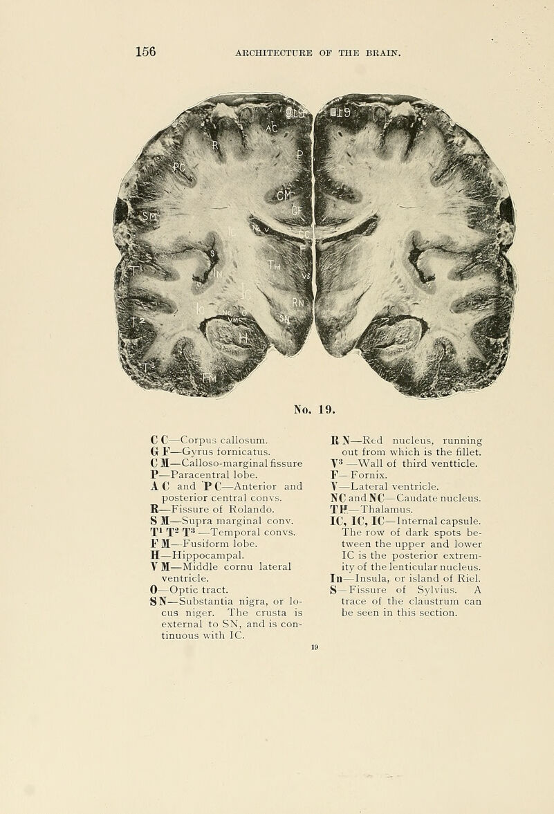 No. 19. C C—Corpus callosum. (j F—Gyrus fornicatus. C M—Calloso-marginal fissure P—Paracentral lobe. A C and 'P C—Anterior and posterior central convs. R—Fissure of Rolando. S M—Supra marginal conv. Ti T^ T** —Temporal convs. F M—Fusiform lobe. H—Hippocampal. VM—Middle cornu lateral ventricle. 0—Optic tract. SN—Substantia nigra, or lo- cus niger. The crusta is external to SN, and is con- tinuous with IC. II N—Red nucleus, running out from which is the fillet. ys —Wall of third ventticle. F—Fornix. Y—Lateral ventricle. NC and N€—Caudate nucleus. TF—Thalamus. IC, IC, IC—Internal capsule. The row of dark spots be- tween the upper and lower IC is the posterior extrem- ity of the lenticular nucleus. In—Insula, or island of Riel. S—Fissure of Sylvius. A trace of the claustrum can be seen in this section.