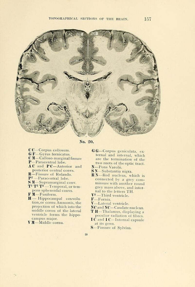 No. 20. CC—Corpus collosum. GrF—Gyrus fornicatus. C M—Calloso-marginal fissure P—Paracentral lobe. AC and PC—Anterior and posterior central convs. R—Fissure of Rolando. P^ —Paracentral lobe. S M—Supramarginal conv. XI T T* —Temporal, or tem- pero sphenoidal convs. F M—Fusiform. H—Hippocampal convolu- tion, or cornu Ammonis, the projection of which into the middle cornu of the lateral ventricle forms the hippo- campus major. V M—Middle cornu. G G—Corpus geniculata, ex- ternal and internal, which are the termination of the two roots of the optic tract. N—Pons Varolii. S N—Substantia nigra. R N—Red nucleus, which is connected b)' a grey com- missure with another round grey mass above, and inter- nal to the letters TH. ys —Third ventricle. F—Fornix. V—Lateral ventricle. NC and NC—Caudate nucleus. T H—Thalamus, displaying a peculiar radiation of fibres. IC and IC—Internal capsule at its genu.