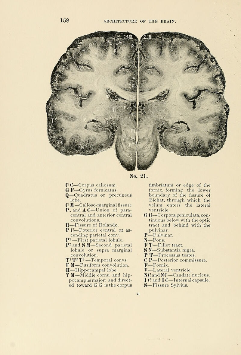 No. 21. C C—Corpus callosum. Gr F—Gyrus fornicatus. Q—Quadratus or precuneus lobe. C M—Calloso-marginal fissure P. and AC—Union of para- central and anterior central convolutions. R—Fissure of Rolando. P C—Poterior central or as- cending parietal conv. pi —First parietal lobule. P^ and S M—Second parietal lobule or supra marginal convolution. rpi rp2 ff s—Temporal convs. F M—Fusiform convolution. H—Hippocampal lobe. Y M—Middle cornu and hip- pocampus major; and direct- fimbriatum or edge of the fornix, forming the lower boundary of the fissure of Bichat, through which the velum enters the lateral ventricle. G G—Corpora geniculata, con- tinuous below with the optic tract and behind with the pulvinar. P—Pulvinar. N—Pons. F T—Fillet tract. S N—Substantia nigra. P T—Processus testes. C P—Posterior commissure. F—Fornix. V—Lateral ventricle. NC and NO—Caudate nucleus. I C and IC—Internal capsule.