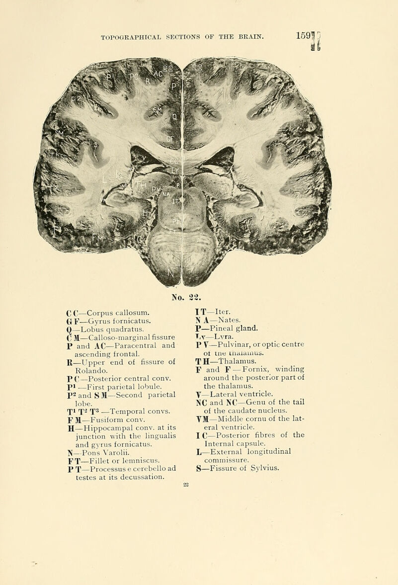 1591 No. 22. C C—Corpus callosum. GrF—Gyrus fornicatus. Q—Lobus quadratus. C M—Calloso-marginal fissure P and AC—Paracentral and ascending frontal. R—Upper end of fissure of Rolando. P C—Posterior central conv. pi.—First parietal lobule. p2andS)I—Second parietal lobe. rpi rji3 rps —Temporal convs. F M—Fusiform conv. H—Hippocampal conv. at its junction with the lingualis and gyrus fornicatus. N—Pons Varolii. FT—Fillet or lemniscus. testes at its decussation. IT—Iter. N A—Nates. P—Pineal gland. T,v—Lvra. P y—Pulvinar, or optic centre ot ine tnaiaiuus. TH—Thalamus. F and F—Fornix, winding around the posterior part of the thalamus. Y—Lateral ventricle. NC and NC—Genu of the tail of the caudate nucleus. YJI—Middle cornu of the lat- eral ventricle. I C—Posterior fibres of the Internal capsule. L—External longitudinal commissure.