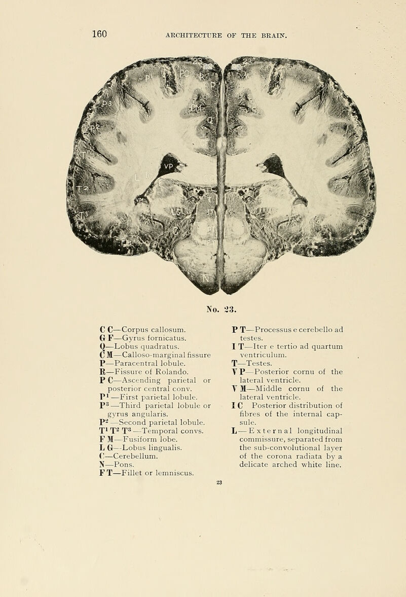 No. 23. C C—Corpus callosum. G F—Gyrus fornicatus. Q—Lobus quadratus. C M—Calloso-marginal fissure P—Paracentral lobule. R—Fissure of Rolando. P C—Ascending parietal or posterior central conv. Pi—First parietal lobule. P*—Third parietal lobule or gyrus angularis. P-—Second parietal lobule. fji ^[2 fs —Temporal convs. F M—Fusiform lobe. L G—Lobus lingualis. C—Cerebellum. N—Pons. FT—Fillet or lemniscus. P T—Processus e cerebello ad testes. I T—Iter e tertio ad quartum ventriculum. T—Testes. VP—Posterior cornu of the lateral ventricle. Y 31—Middle cornu of the lateral ventricle. IC Posterior distribution of fibres of the internal cap- sule. L—External longitudinal commissure, separated from the sub-convolutional la}'er of the corona radiata by a delicate arched white line.