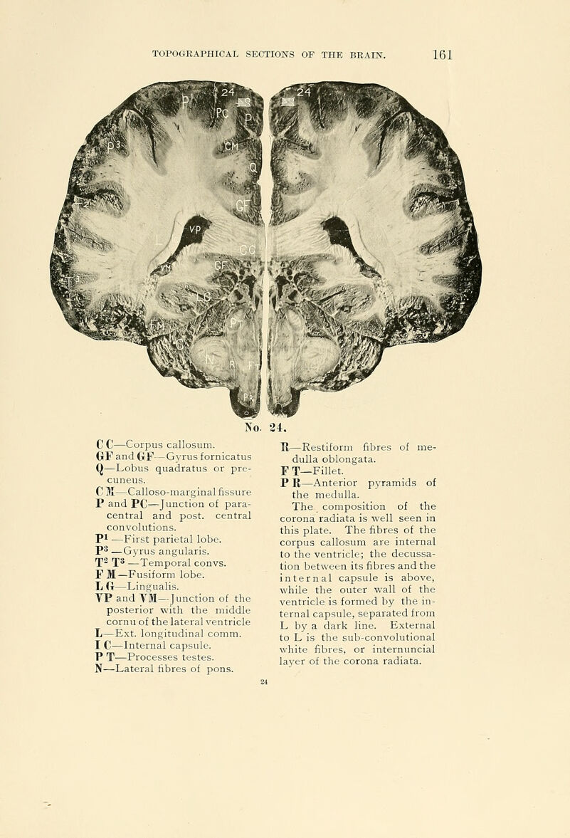C C—Corpus callosum. GrF and GF—Gyrus fornicatus Q—Lobus quadratus or pre- cuneus. C 31—Calloso-marginal fissure P and PC—Junction of para- central and post, central convolutions. Pi ■—First parietal lobe. P^ —Gj'rus angularis. rj\2 ff 3 ,—Temporal convs. F M—Fusiform lobe. L (t—Lingualis. YP and TM—Junction of the posterior with the middle cornu of the lateral ventricle L—Ext. longitudinal comm. I C—Internal capsule. P T—Processes testes. N—Lateral fibres of pons. R—Restiform fibres of me- dulla oblongata. FT—Fillet. P R—Anterior pyramids of the medulla. The composition of the corona radiata is well seen in this plate. The fibres of the corpus callosum are internal to the ventricle; the decussa- tion between its fibres and the internal capsule is above, while the outer wall of the ventricle is formed by the in- ternal capsule, separated from L by a dark line. External to L is the sub-convolutional white fibres, or internuncial layer of the corona radiata.