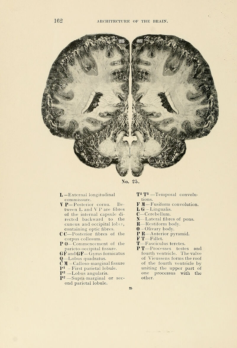 No. 25. L—External longitudinal commissure. V P—Posterior cornu. Be- tween L and V P are fibres of the internal capsule di- rected backward to the cuneus and occipital lobtf, containing optic fibres. C C—Posterior fibres of the corpus collosum. P 0— Commencement of the parieto-occipital fissure. GF and GF—Gyrus fornicatus Q—Lobus quadratus. C M —Calloso-marginal fissure pi —First parietal lobule. P^ —Lobus angularis. P'^ —Supra-marginal or sec- ond parietal lobule. IJ2 rps —Temporal convolu- tions. F H—Fusiform convolution. L G — Lingualis. C—Cerebellum. N—Lateral fibres of pons. R—Restiform body. 0—Olivary body. P R—Anterior pyramid. F T—Fillet. T—Fasciculus teretes. P T—Processes testes and fourth ventricle. The valve of Vieussens forms the roof of the fourth ventricle by uniting the upper part of one processus with the other.