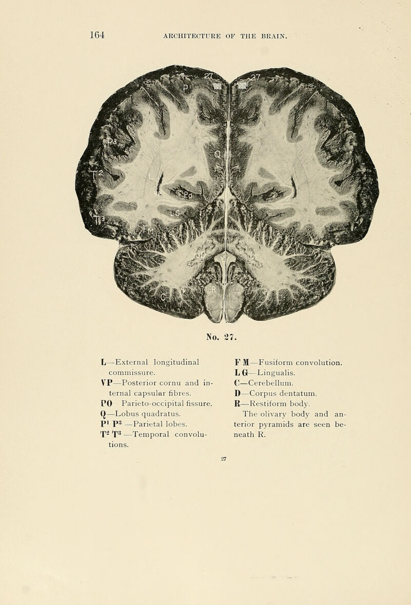 No. 27. L—External longitudinal commissure. VP—Posterior cornu and in- ternal capsular fibres. PO Parieto-occipital fissure. Q—Lobus quadratus. pi ps —Parietal lobes. rf2 rps —Temporal convolu- tions. F M—Fusiform convolution. L G—Lingualis. C—Cerebellum. D—Corpus dentatum. R—Restiform body. The olivary body and an- terior pyramids are seen be- neath R.