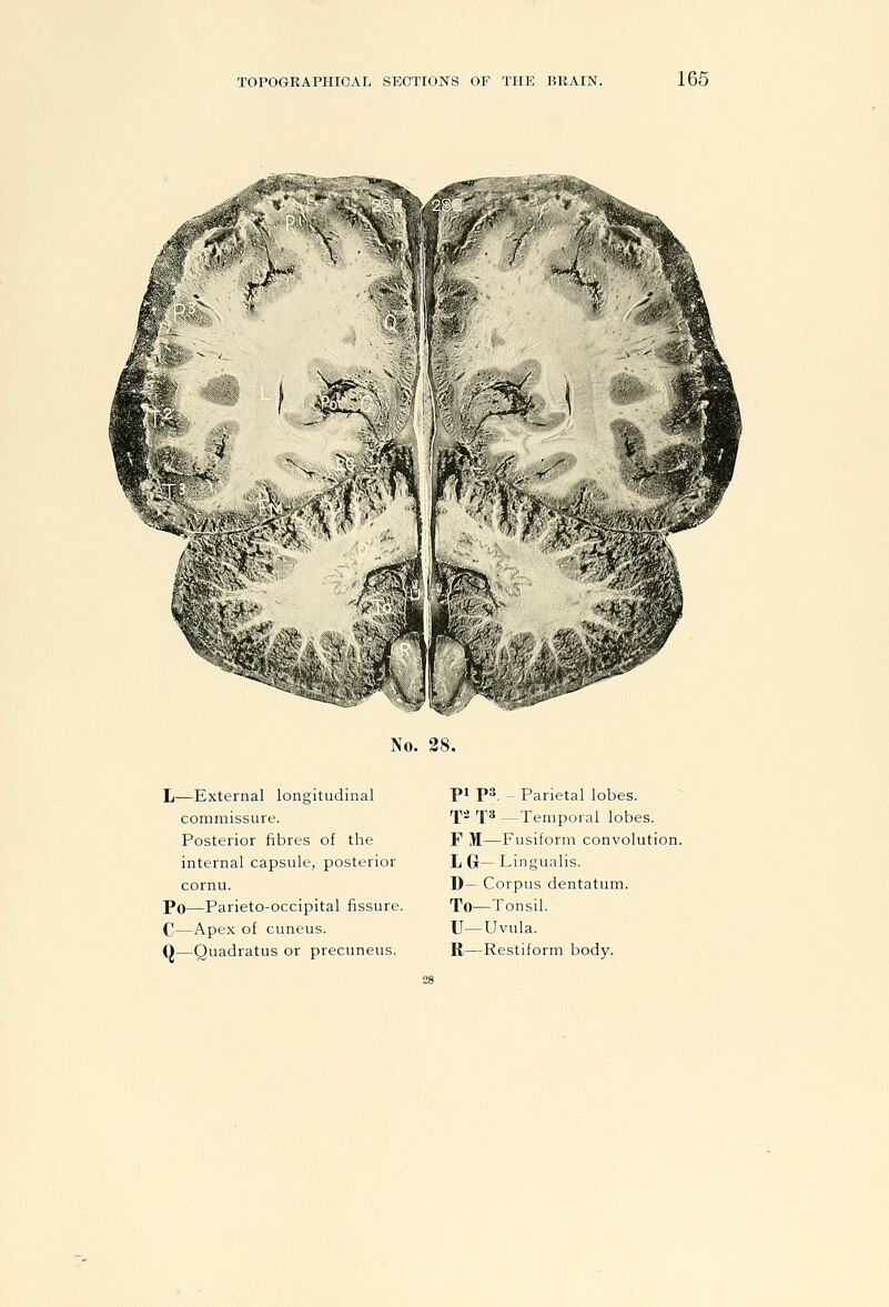 166 S^A 1^' \ J It /, ''^r'*.-t i«^< No. 28. L-—External longitudinal commissure. Posterior fibres of the internal capsule, posterior cornu. Po—Parieto-occipital fissure. C—Apex of cuneus. Q—Quadratus or precuneus. Pi ps. ~ Parietal lobes. rji2 rps —Temporal lobes. F M—Fusiform convolution. L G— Lingualis. D— Corpus dentatum. To—Tonsil. U—Uvula. R—Restiform body.