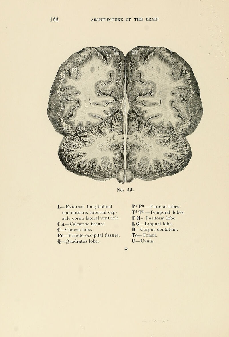 »:,, ^1 'if No. 29. L—External longitudinal commissure, internal cap- sule, cornu lateral ventricle. C A—Calcarine fissure. C^—Cuneus lobe. Po—Parieto-occipital fissure. Q—Quadratus lobe. pi ps _Parietal lobes. 'J2 f 3 —Temporal lobes. F M- Fusiform lobe. L 6—Lingual lobe. D—Corpus dentatum. To—Tonsil. XJ_Uvula.