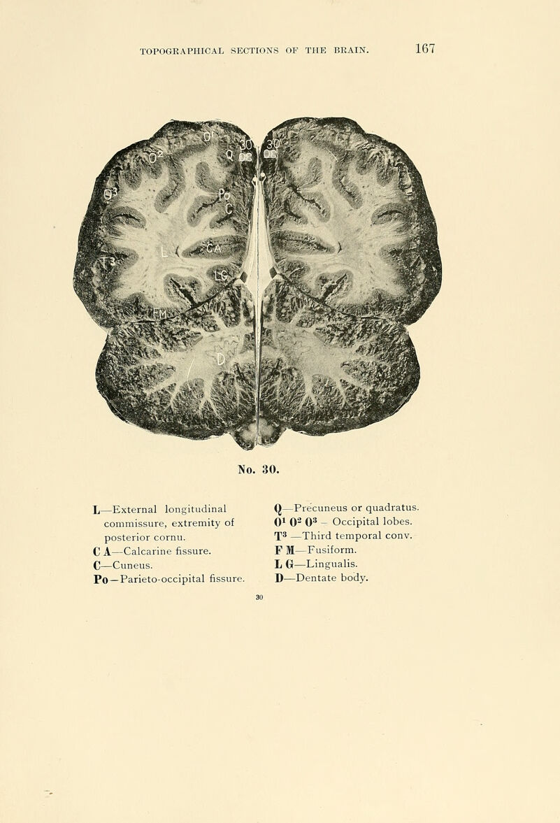 No. 30. L—External longitudinal commissure, extremity of posterior cornu. C A—Calcarine fissure. C—Cuneus. Po—Parieto-occipital fissure. Q—Precuneus or quadratus. Qi 02 O'* - Occipital lobes. T^ —Third temporal conv. F M—Fusiform. L G—Lingualis. D—Dentate body.